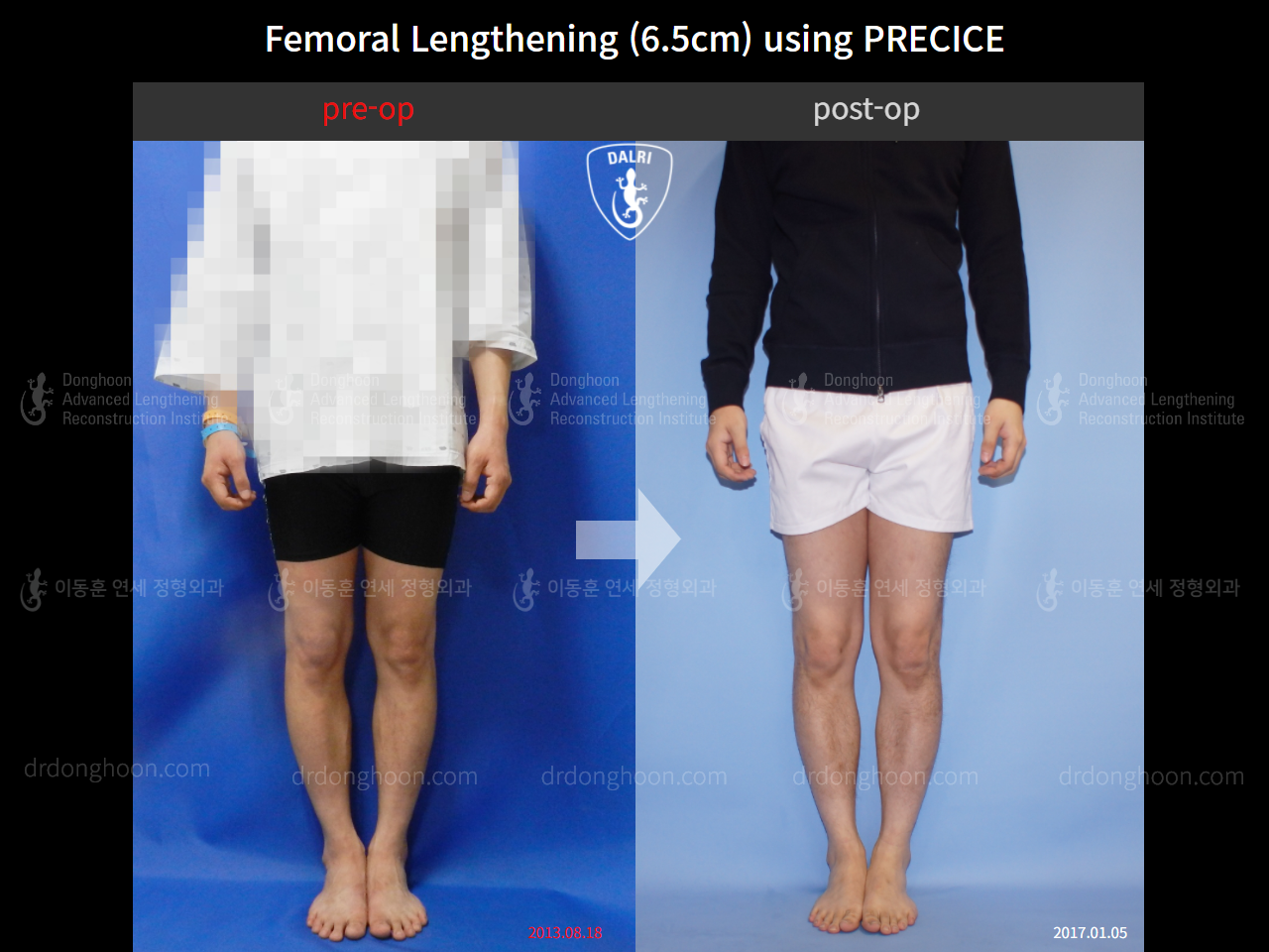 Before and after cll precice, case 4323401, image 1, Dr. Donghoon institute (DALRI)