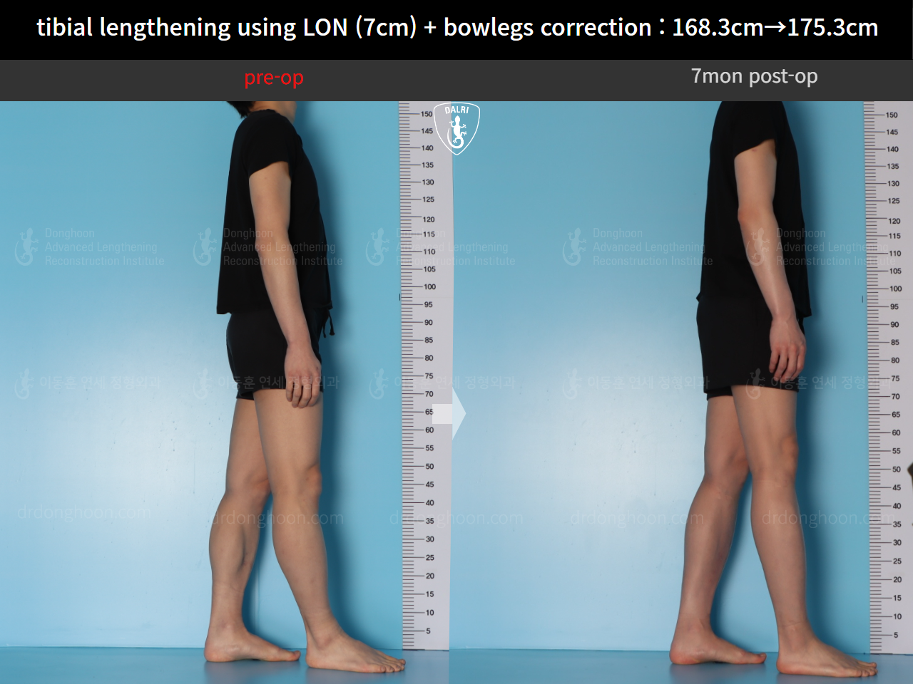 Before and after cll + deformity correction, case 21918246, image 5, Dr. Donghoon institute (DALRI)