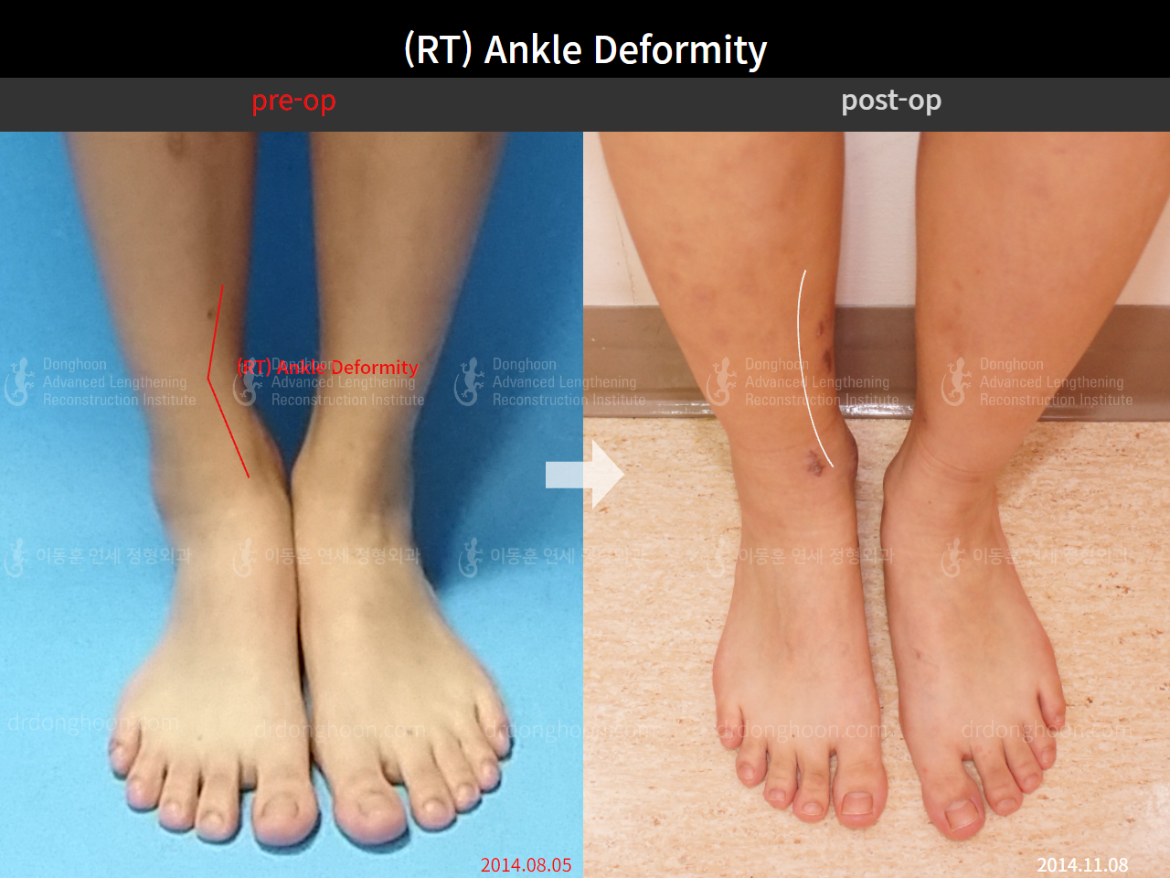 Before and after foot & ankle deformity, case 4248008, image 3, Dr. Donghoon institute (DALRI)