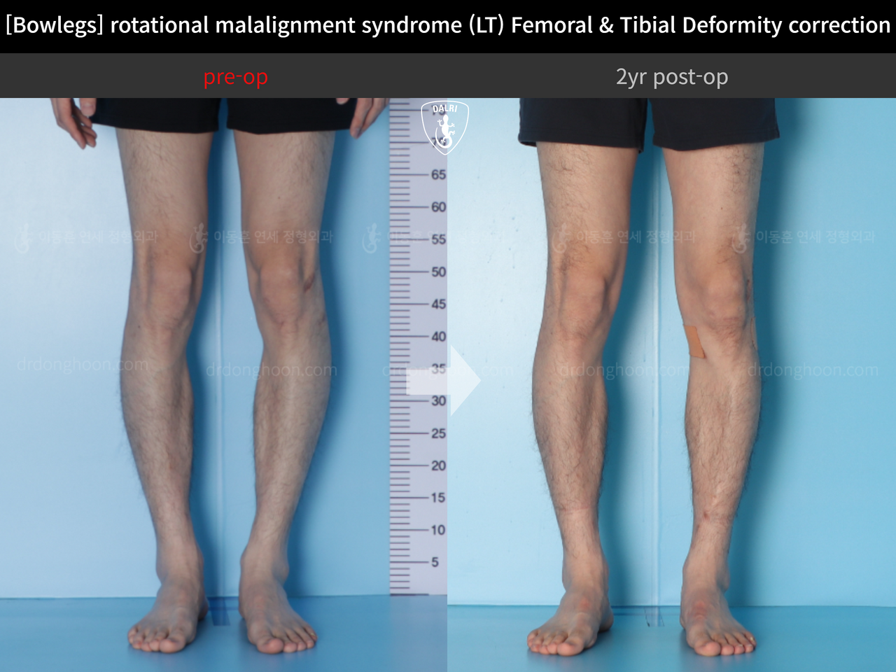 Before and after adult bowlegs, case 13266718, image 7, Dr. Donghoon institute (DALRI)