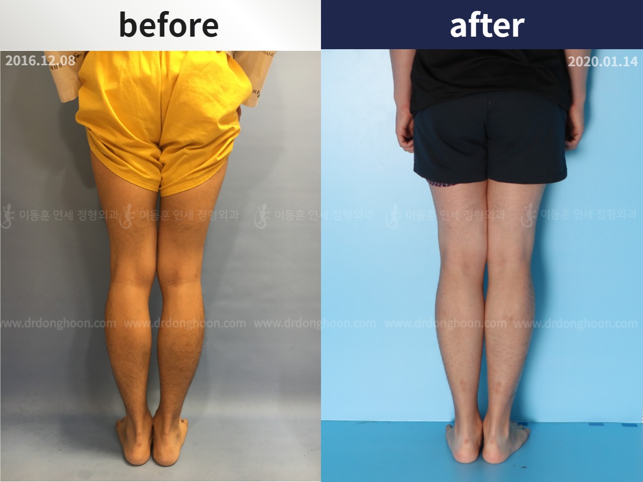 Before and after cll lon, case 4323443, image 2, Dr. Donghoon institute (DALRI)