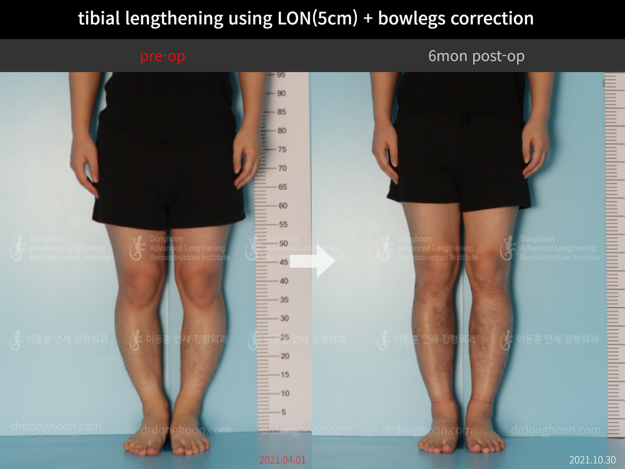 Before and after cll + deformity correction, case 11925306, image 5, Dr. Donghoon institute (DALRI)