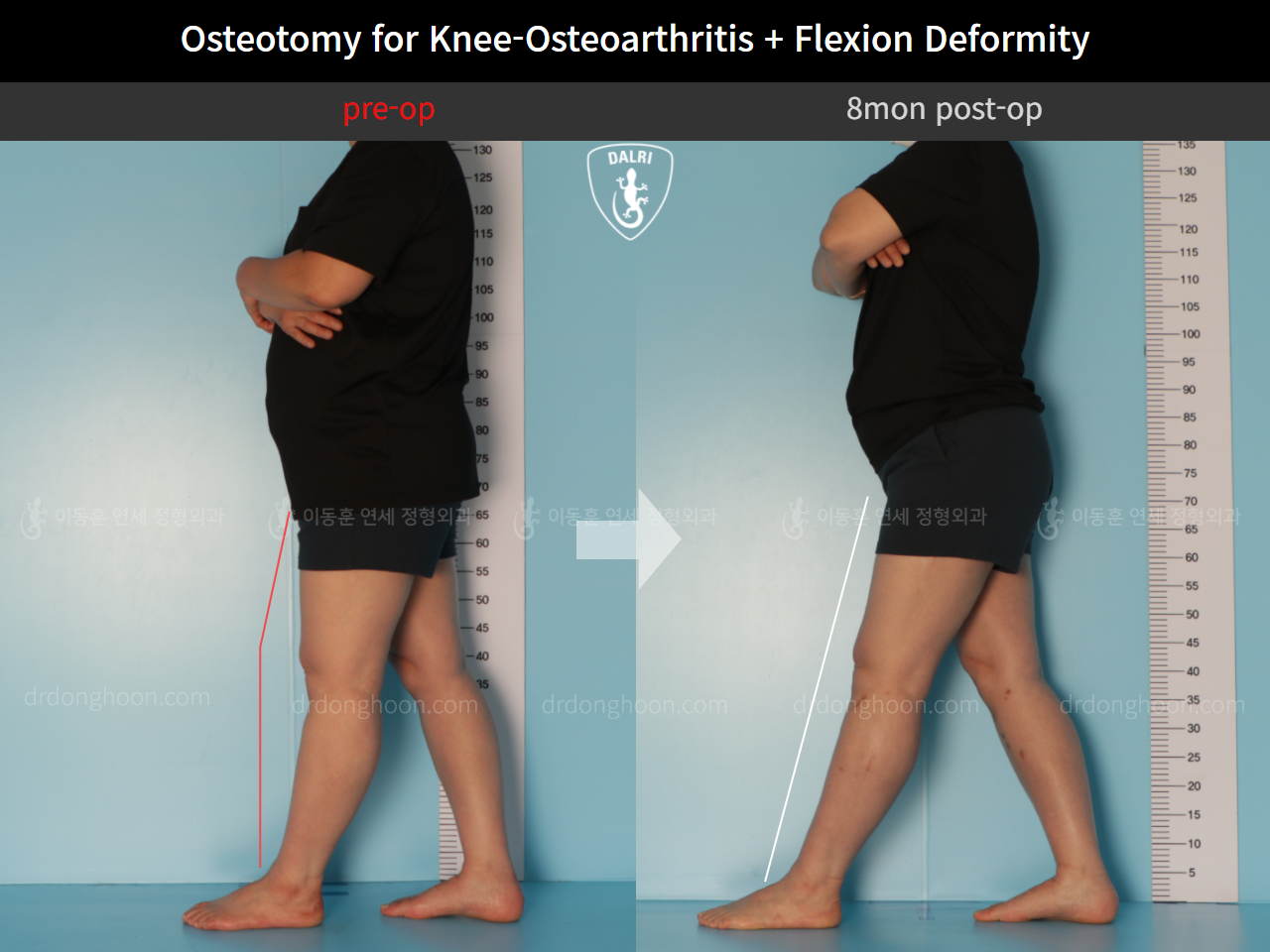 Before and after osteotomy for knee osteoarthritis, case 10663581, image 4, Dr. Donghoon institute (DALRI)