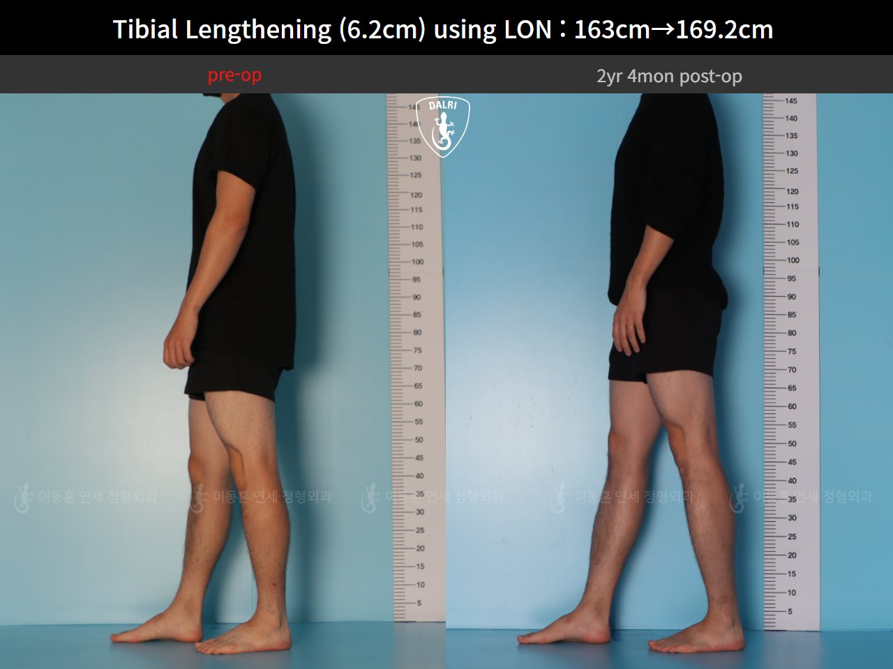 Before and after cll lon, case 128449546, image 4, Dr. Donghoon institute (DALRI)