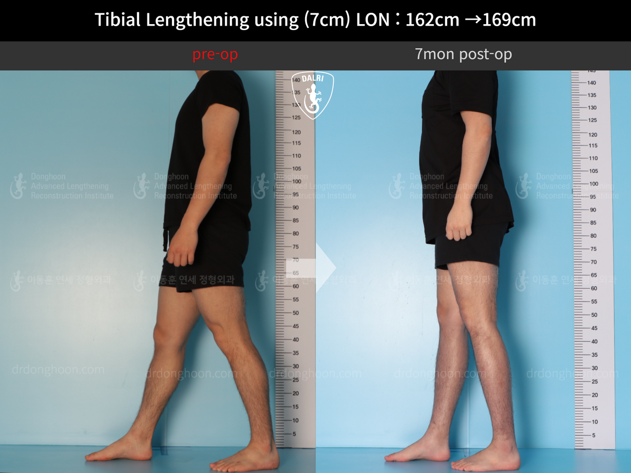Before and after cll lon, case 13743472, image 8, Dr. Donghoon institute (DALRI)