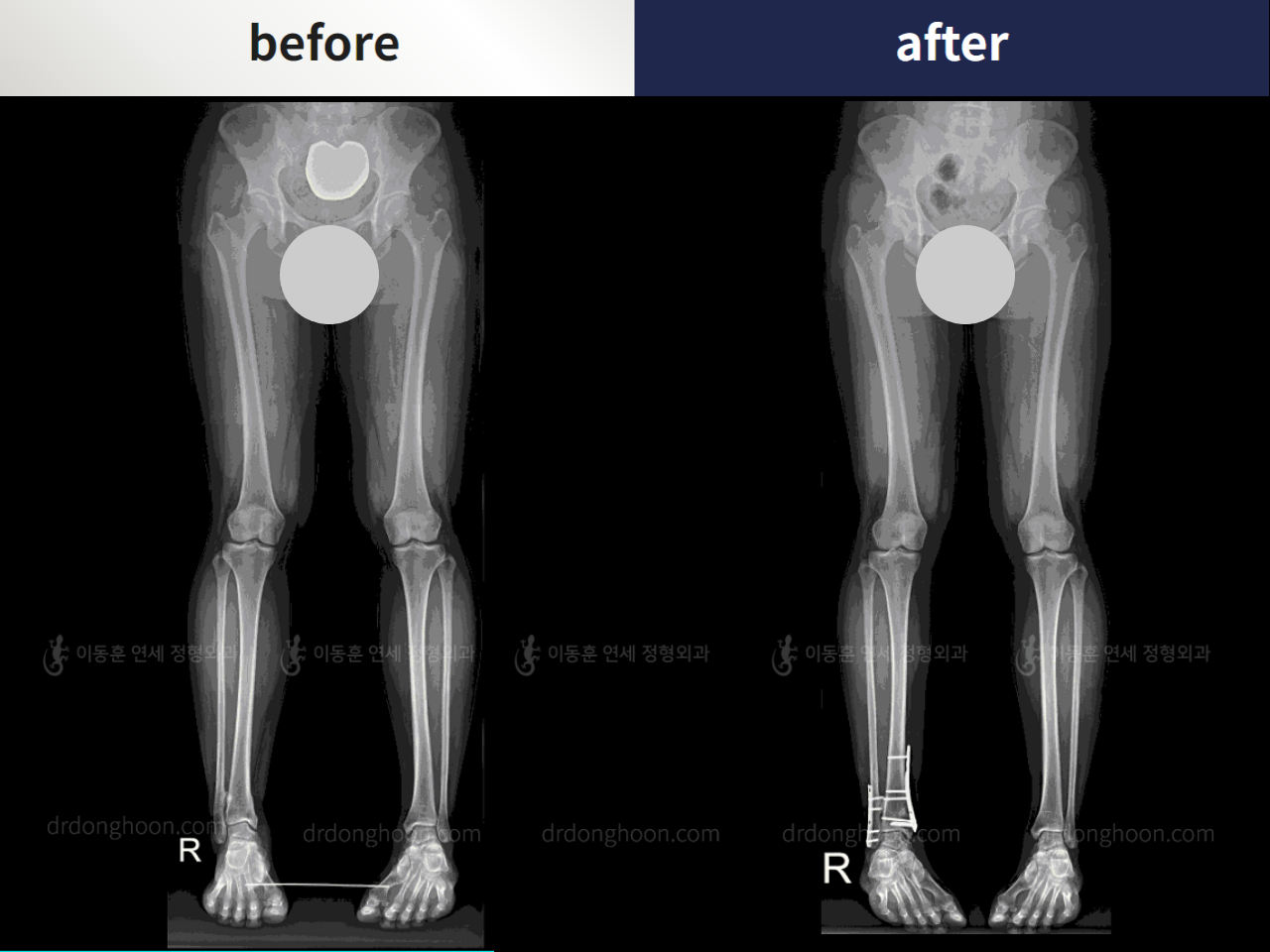 Before and after foot & ankle deformity, case 4247987, image 5, Dr. Donghoon institute (DALRI)