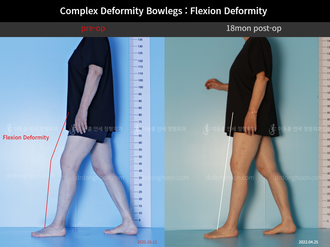 Before and after flexion deformity, case 11337466, image 3, Dr. Donghoon institute (DALRI)