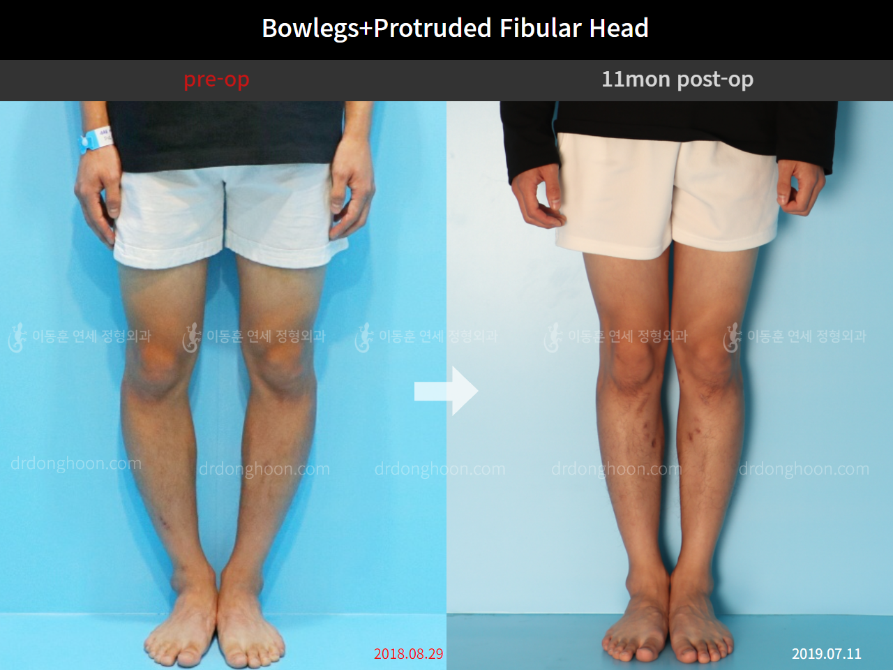 Before and after protruded fibular head, case 4248372, image 4, Dr. Donghoon institute (DALRI)