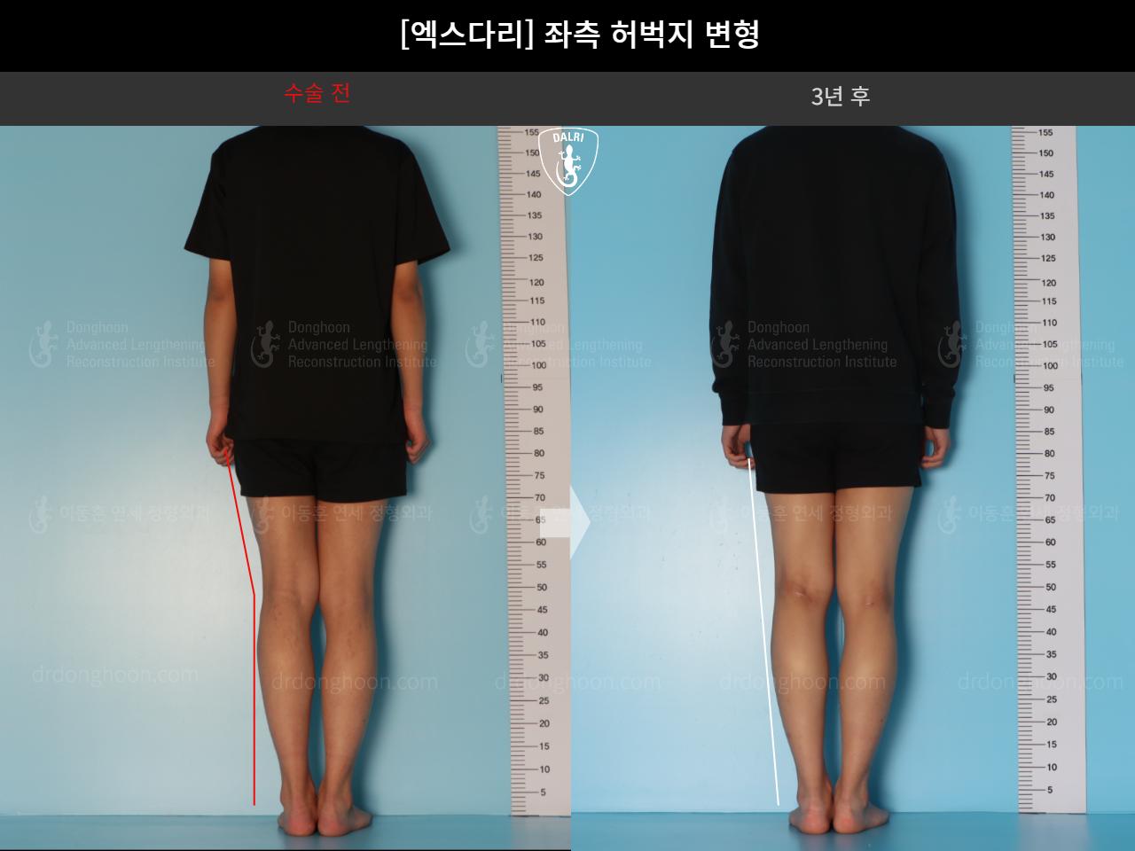 Before and after adult knock knees, case 18261918, image 3, Dr. Donghoon institute (DALRI)