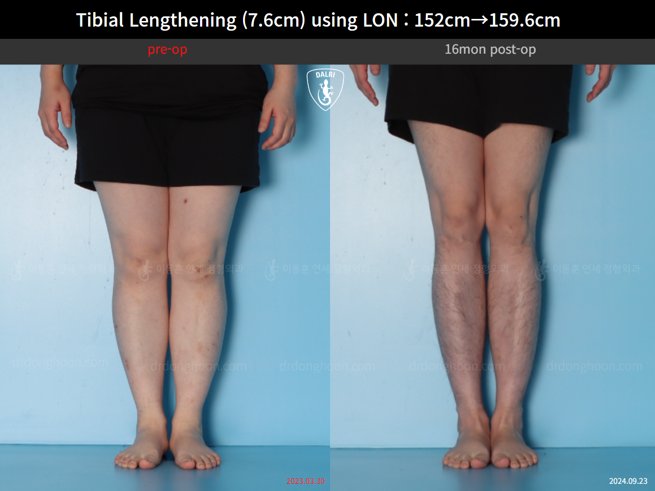 Before and after cll lon, case 123804178, image 5, Dr. Donghoon institute (DALRI)
