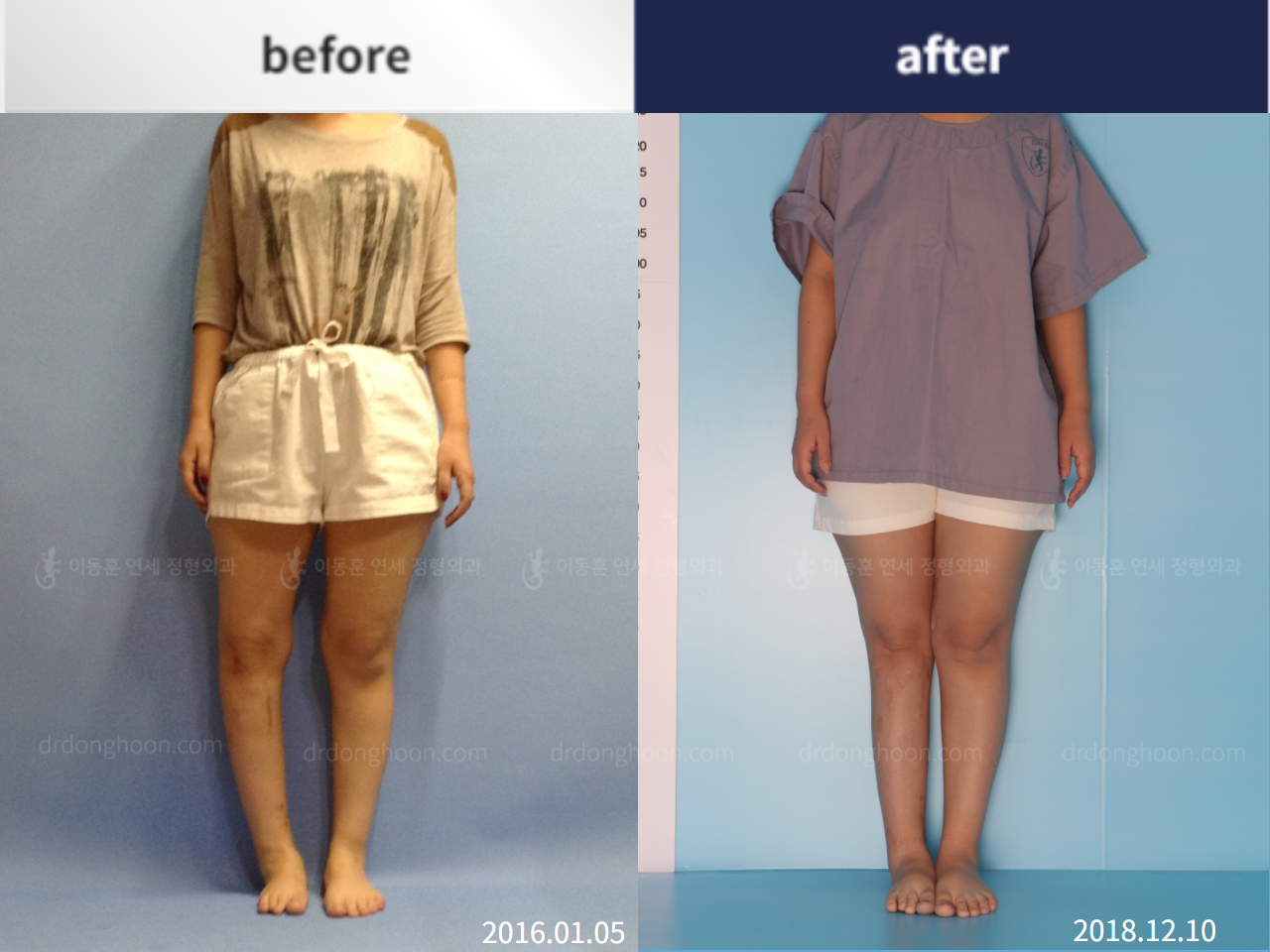 Before and after re-operation for cll, case 5332854, image 1, Dr. Donghoon institute (DALRI)