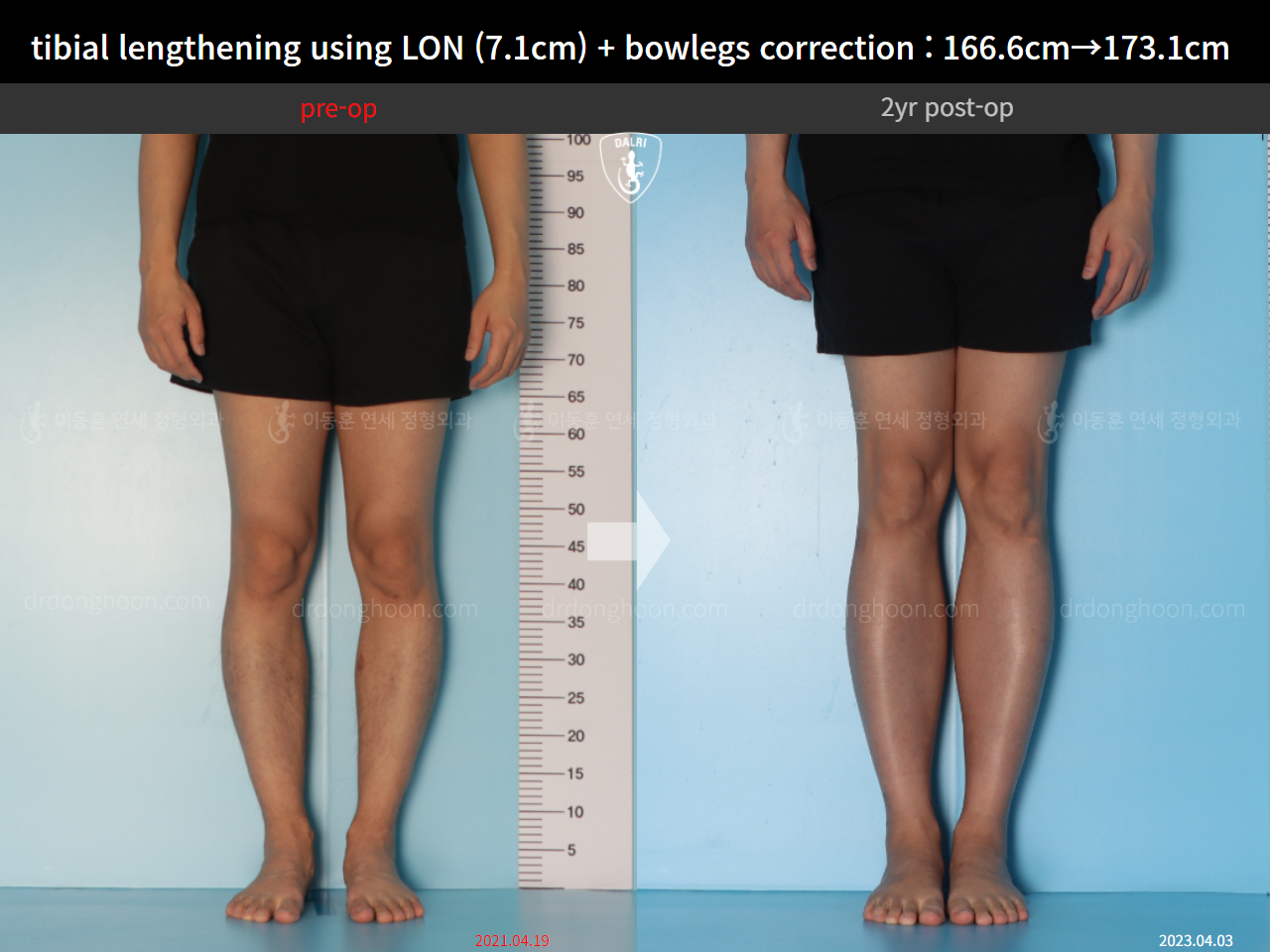 Before and after cll lon, case 14678740, image 7, Dr. Donghoon institute (DALRI)