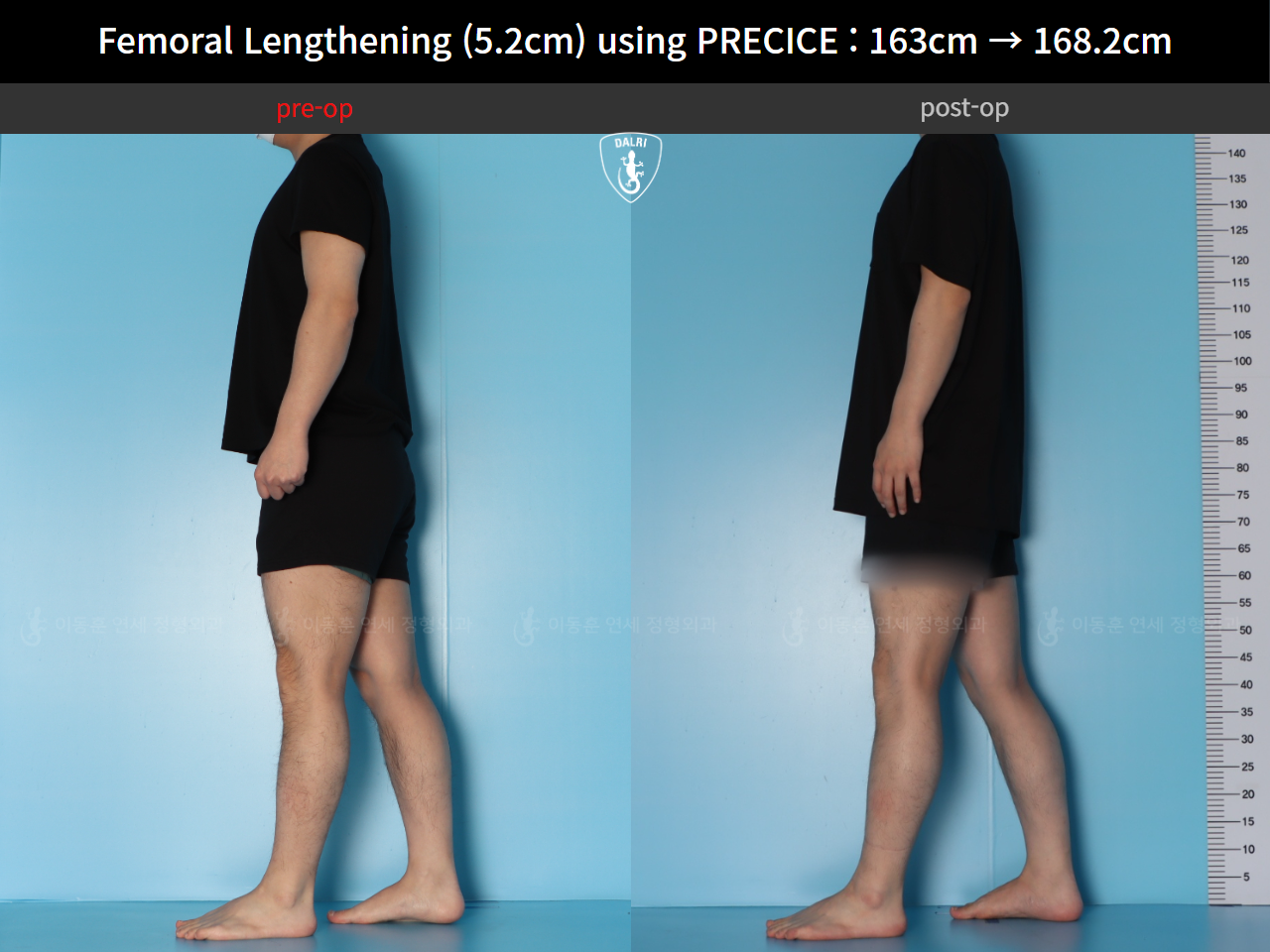 Before and after cll precice, case 55585697, image 3, Dr. Donghoon institute (DALRI)