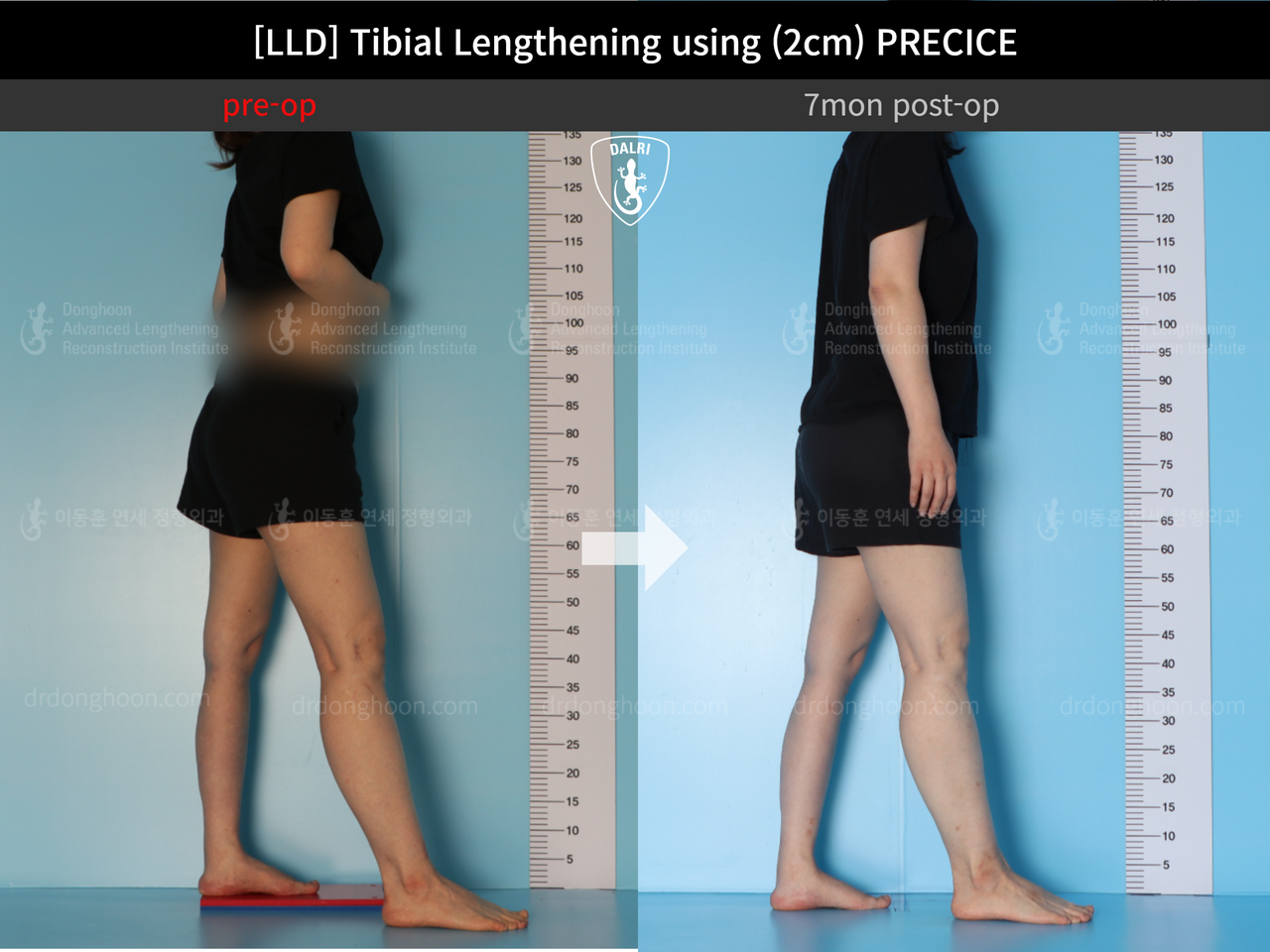 Before and after adult lld, case 12985023, image 4, Dr. Donghoon institute (DALRI)