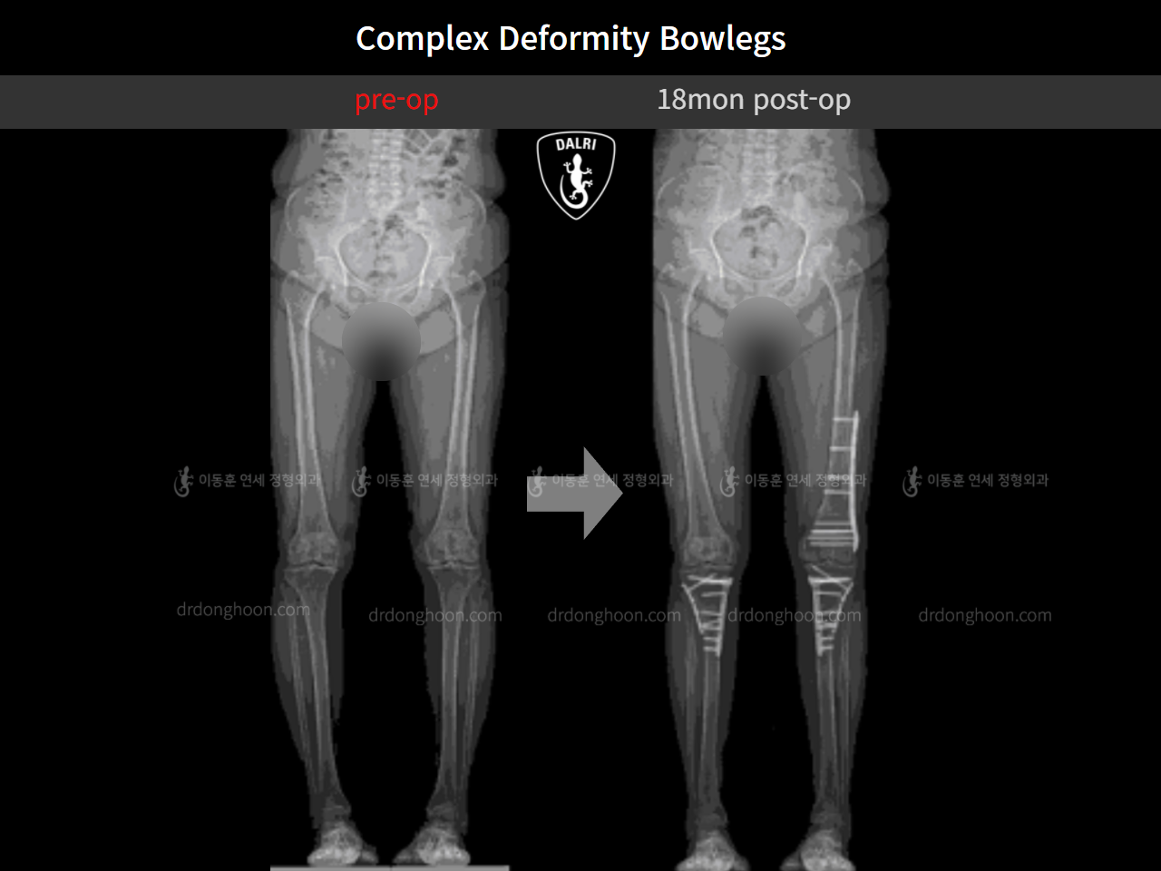 Before and after osteotomy for knee osteoarthritis, case 11337460, image 9, Dr. Donghoon institute (DALRI)