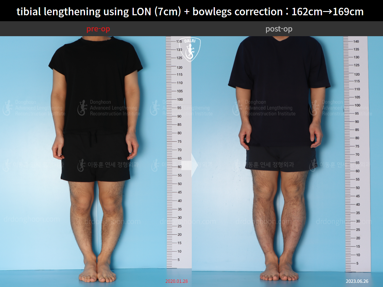 Before and after cll + deformity correction, case 15545055, image 1, Dr. Donghoon institute (DALRI)