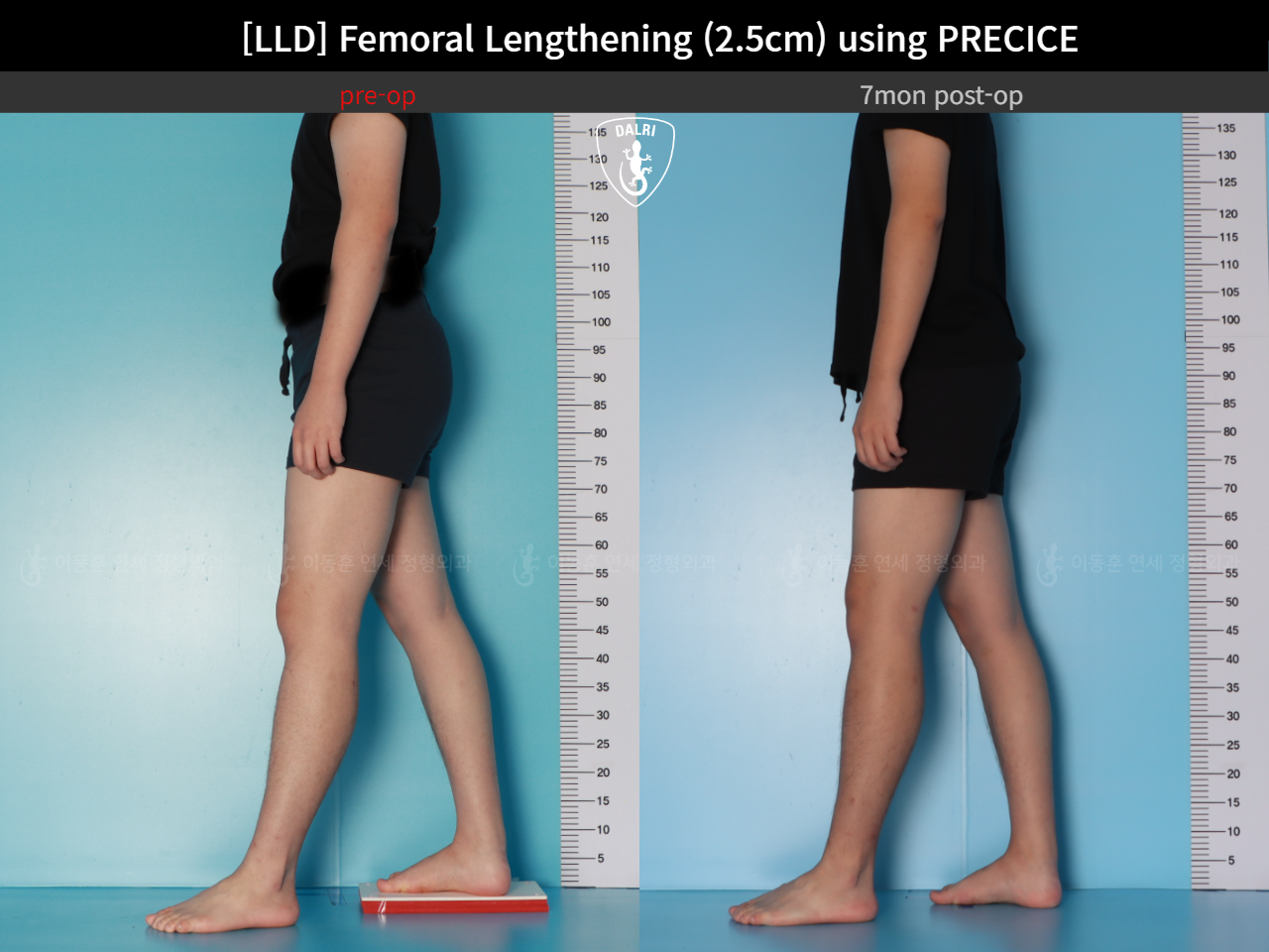 Before and after adult lld, case 127180202, image 4, Dr. Donghoon institute (DALRI)