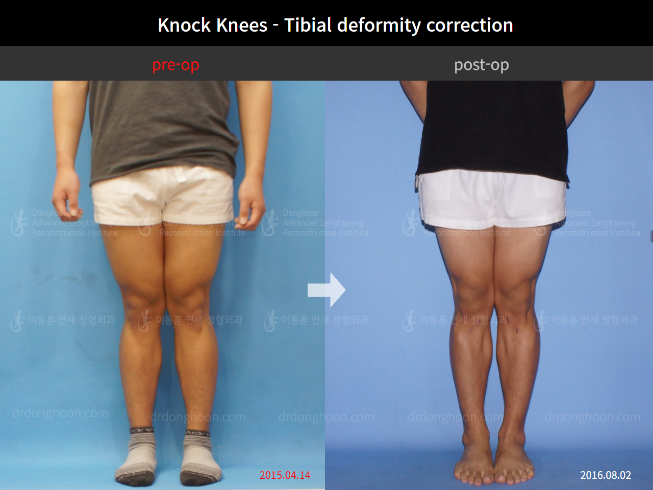Before and after adult knock knees, case 4310817, image 1, Dr. Donghoon institute (DALRI)