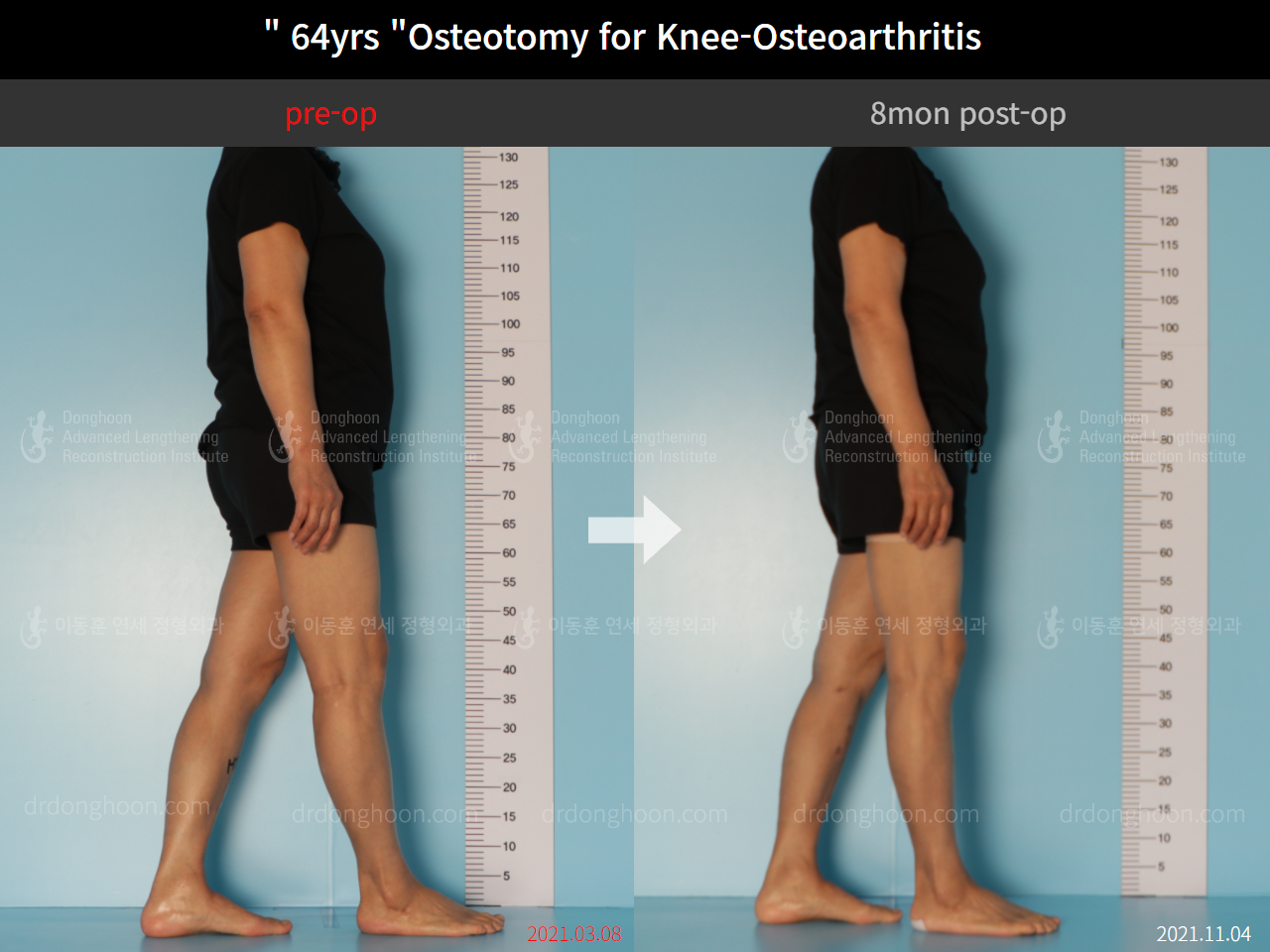 Before and after osteotomy for knee osteoarthritis, case 8761106, image 3, Dr. Donghoon institute (DALRI)