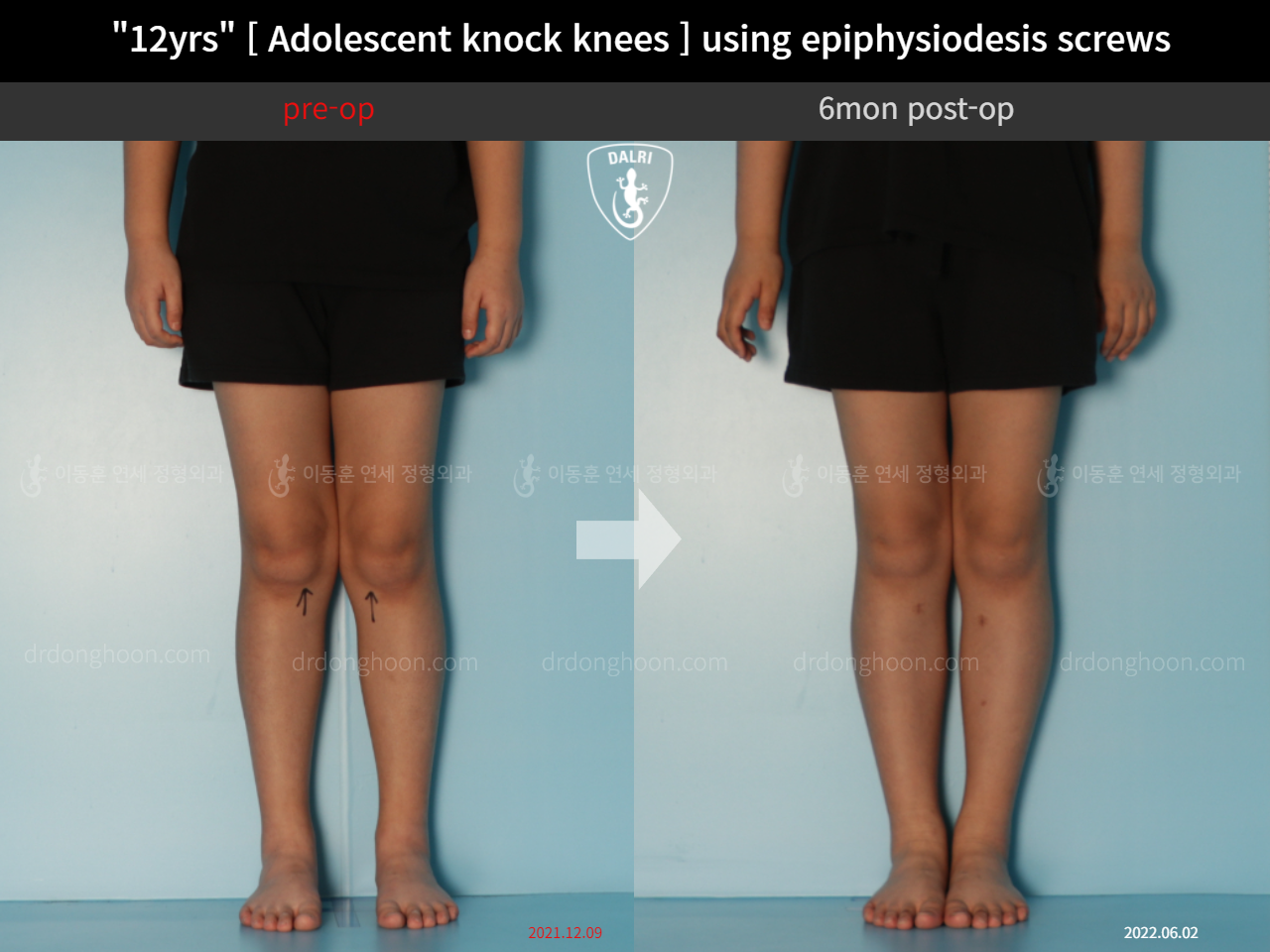 Before and after paediatric & adolescent knock knees, case 11772990, image 3, Dr. Donghoon institute (DALRI)