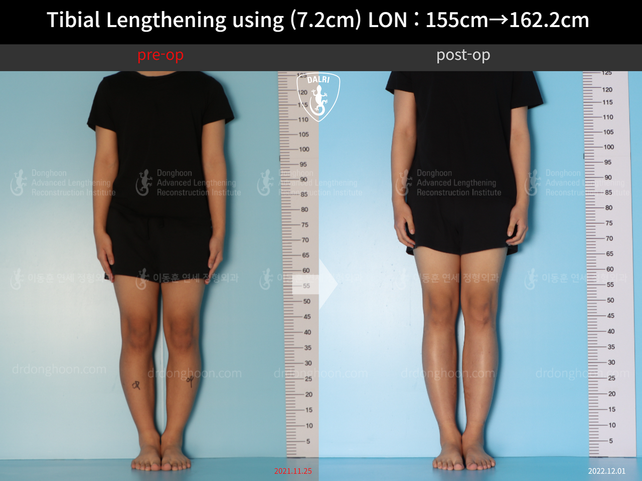 Before and after cll lon, case 13635674, image 1, Dr. Donghoon institute (DALRI)