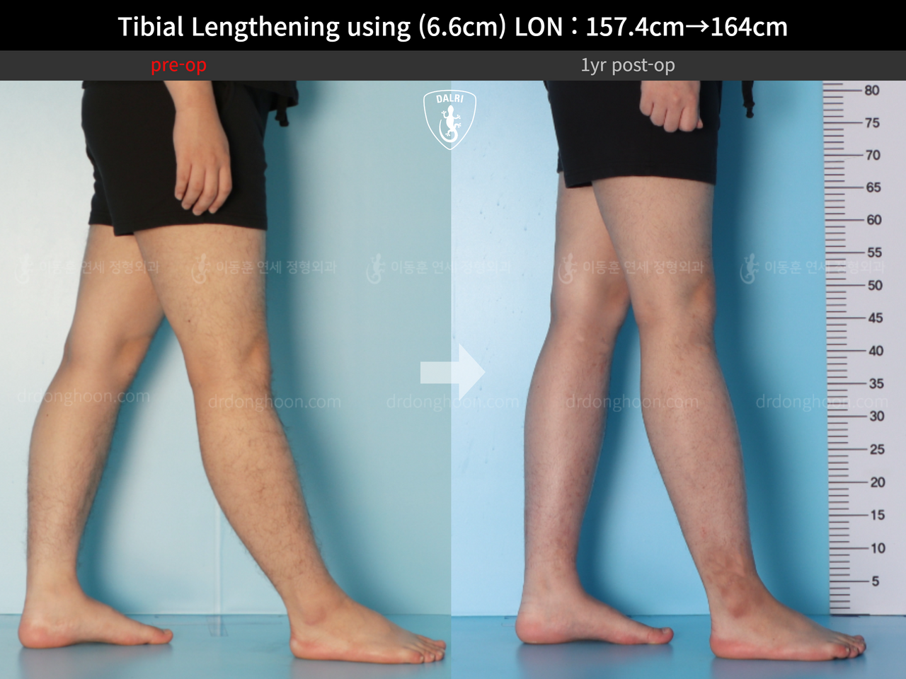 Before and after cll lon, case 13418098, image 7, Dr. Donghoon institute (DALRI)