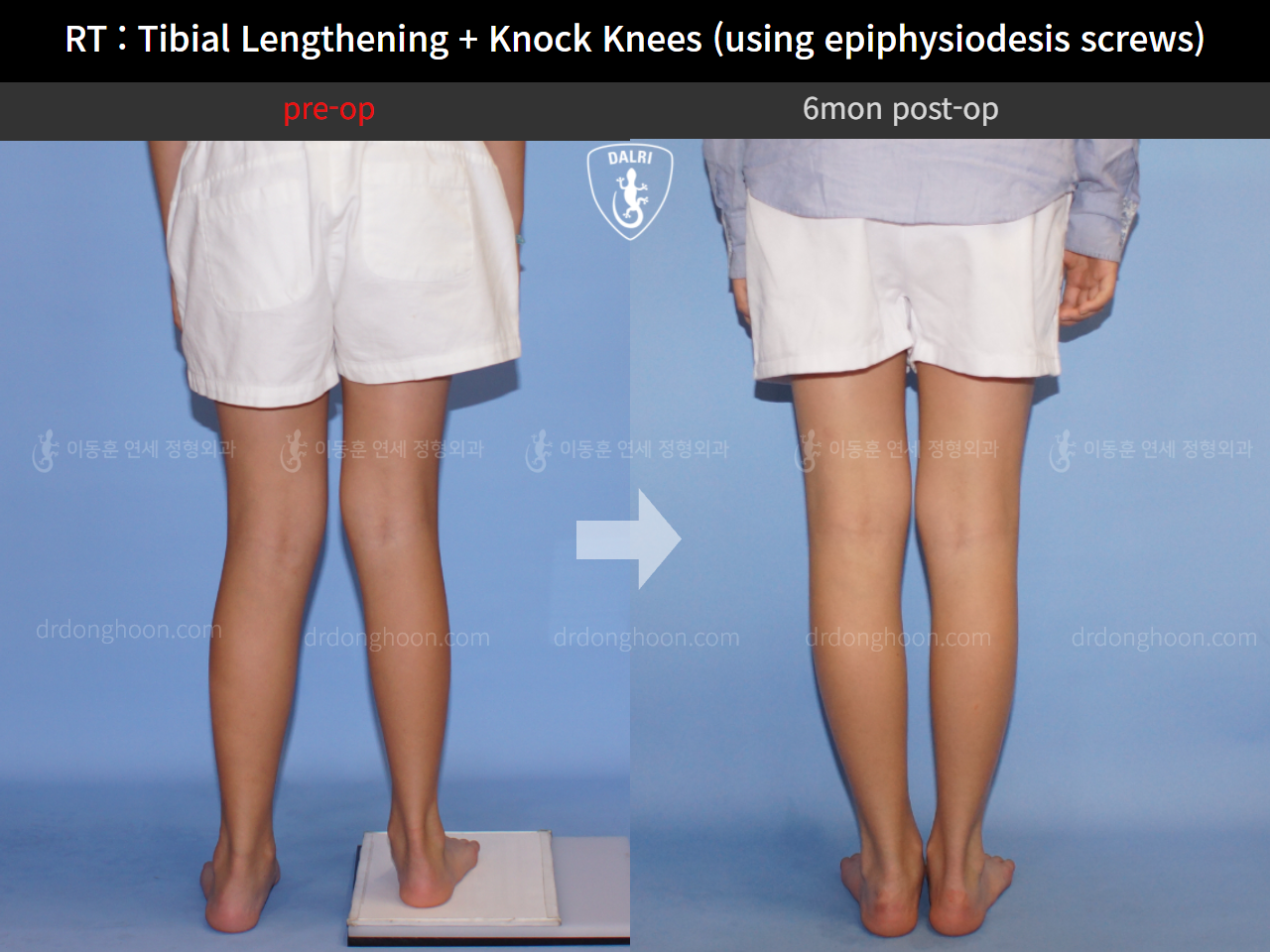 Before and after paediatric & adolescent lld, case 4320397, image 4, Dr. Donghoon institute (DALRI)