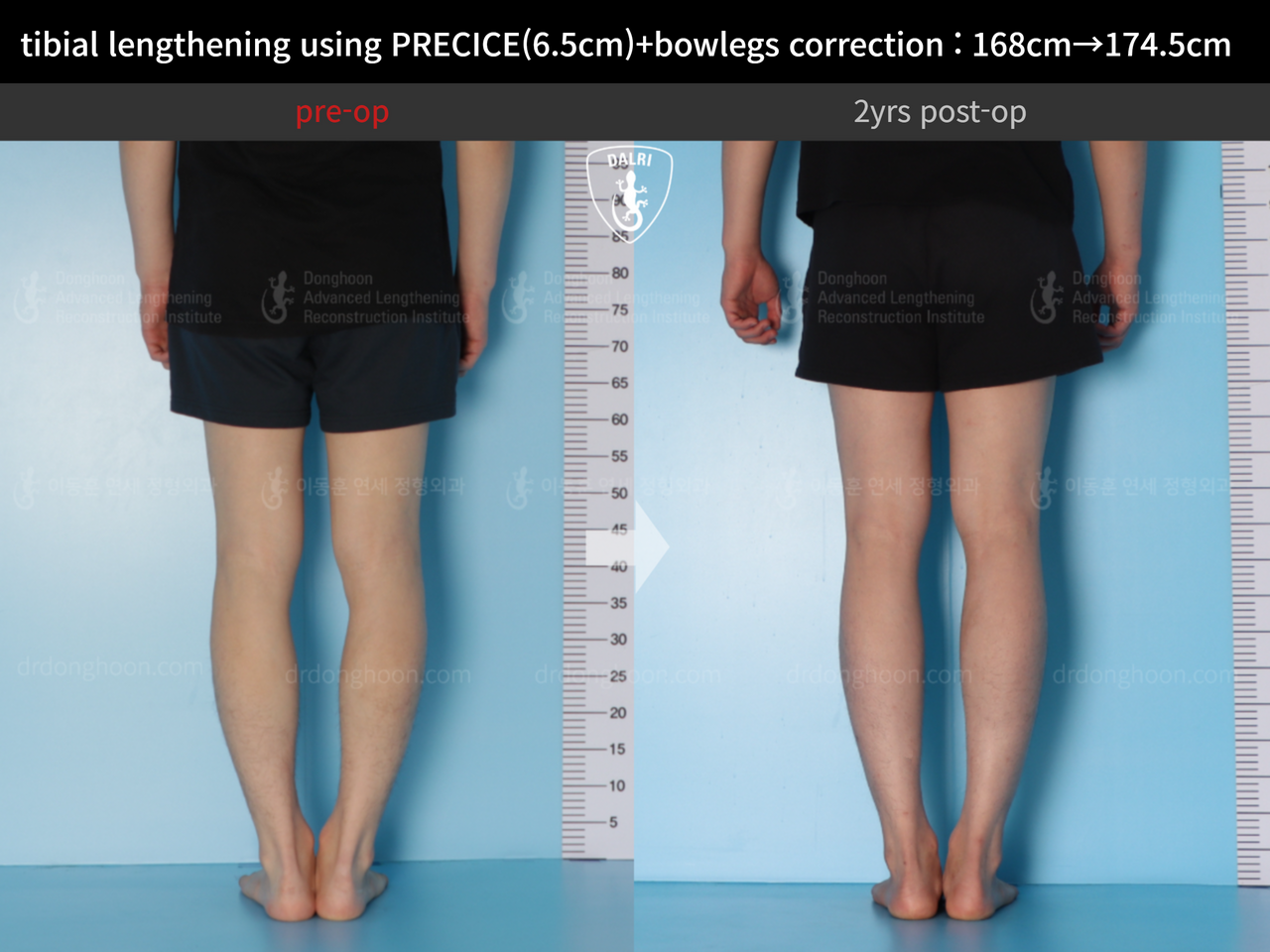 Before and after cll precice, case 12409993, image 7, Dr. Donghoon institute (DALRI)