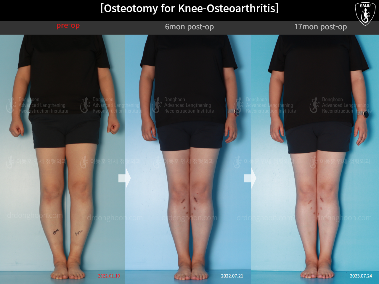 Before and after osteotomy for knee osteoarthritis, case 15944917, image 1, Dr. Donghoon institute (DALRI)