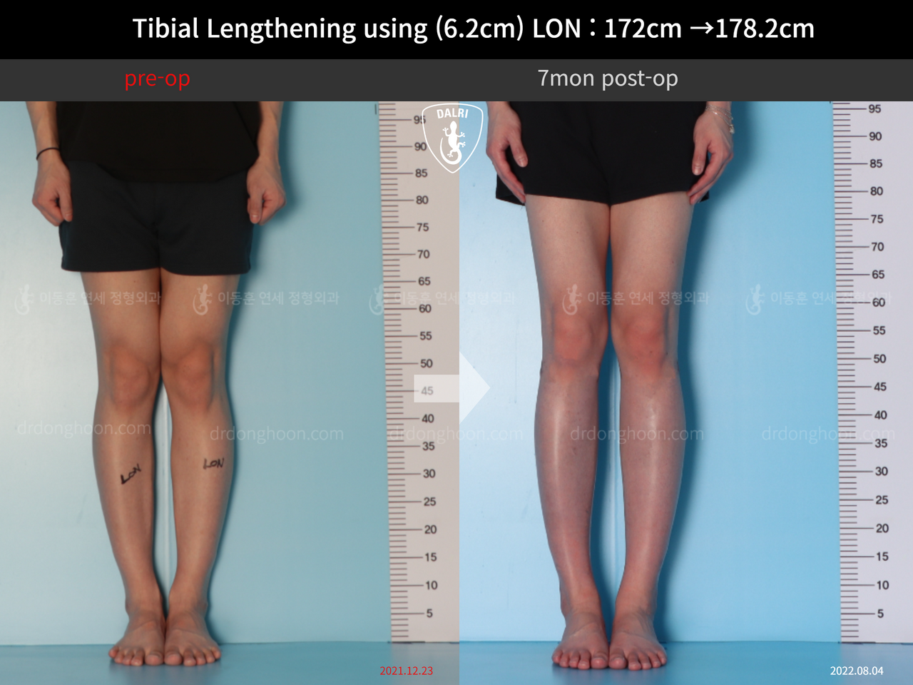 Before and after cll lon, case 12519142, image 5, Dr. Donghoon institute (DALRI)