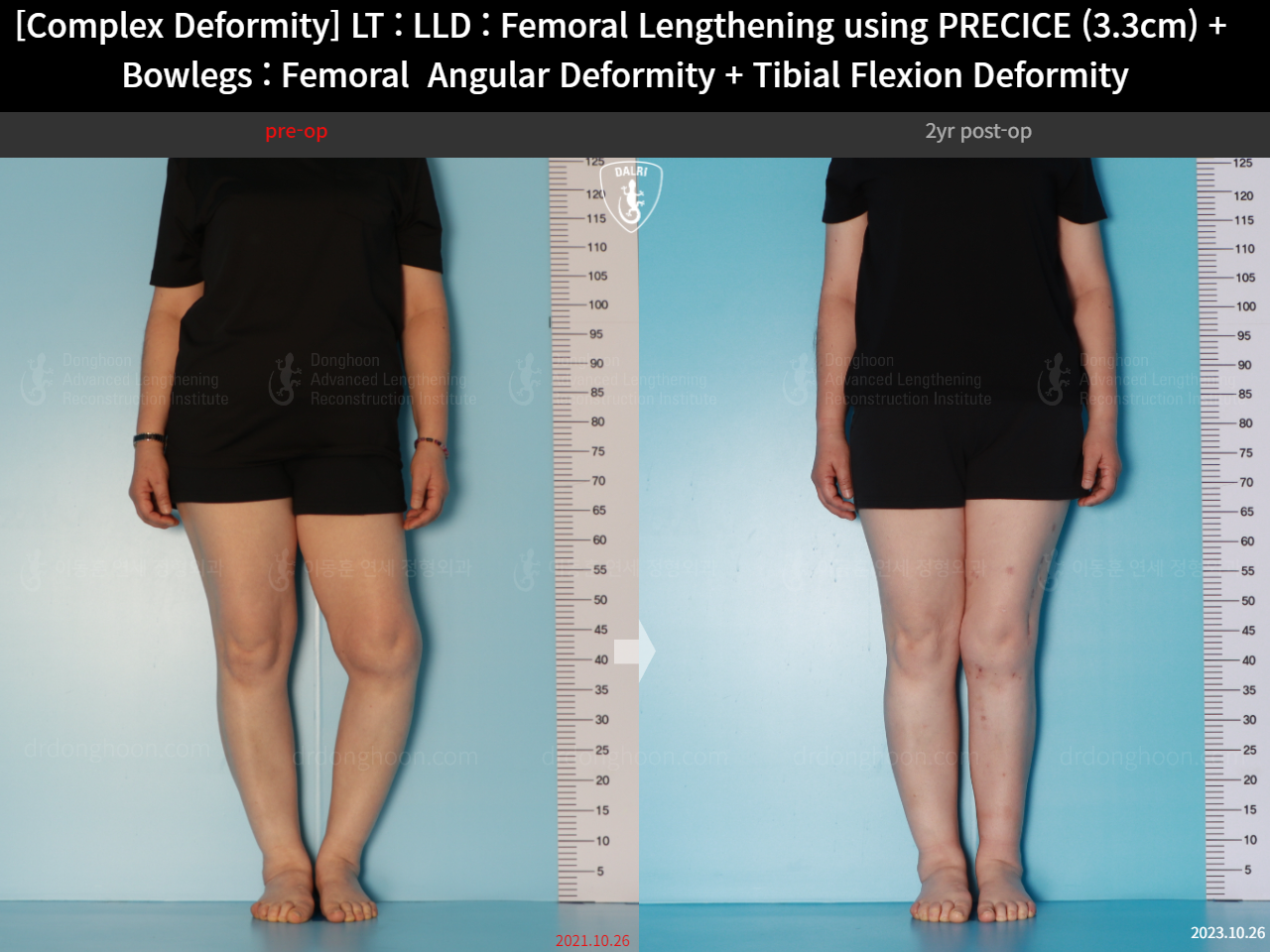 Before and after adult lld, case 16786688, image 6, Dr. Donghoon institute (DALRI)