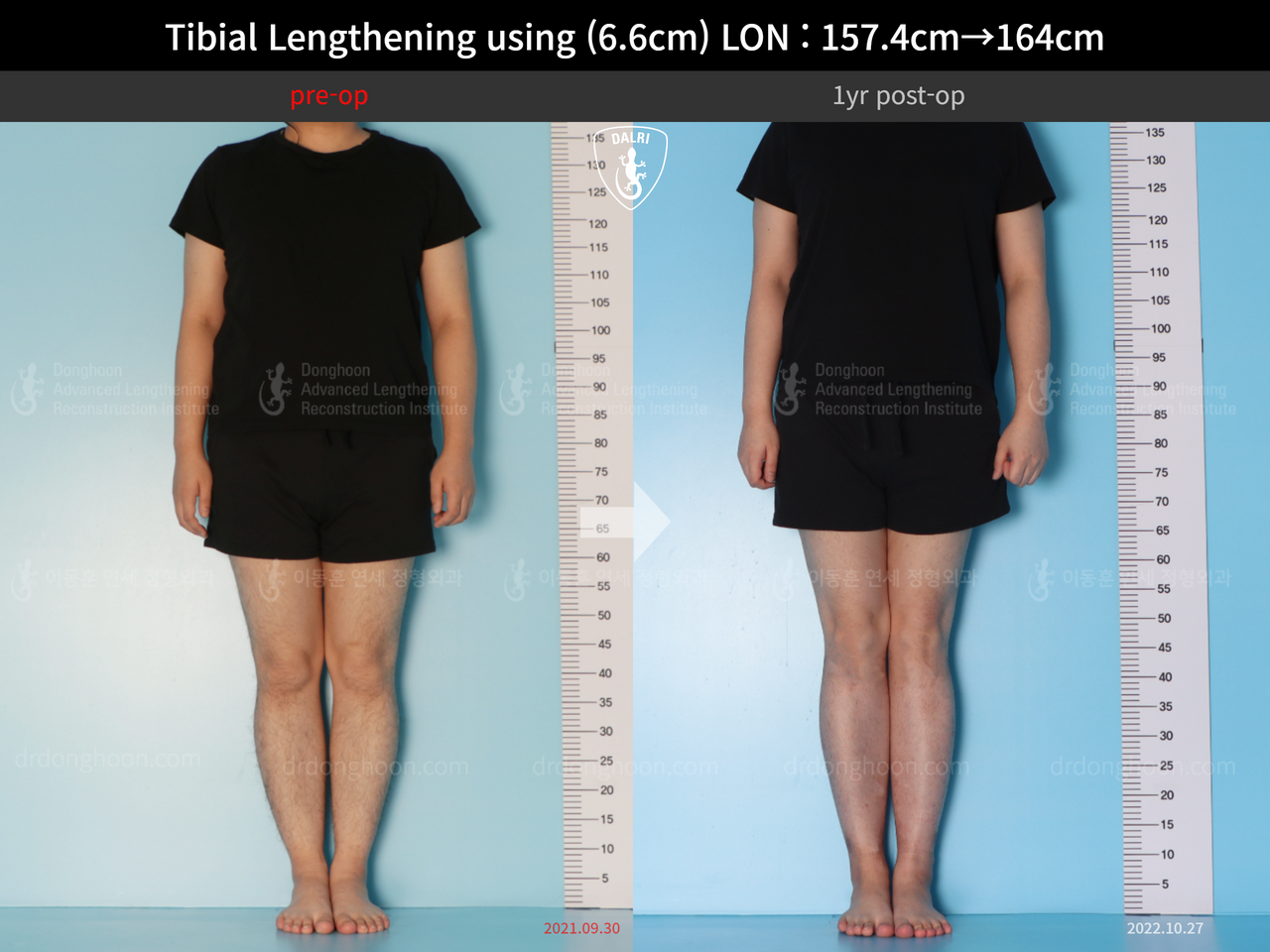 Before and after cll lon, case 13418098, image 1, Dr. Donghoon institute (DALRI)