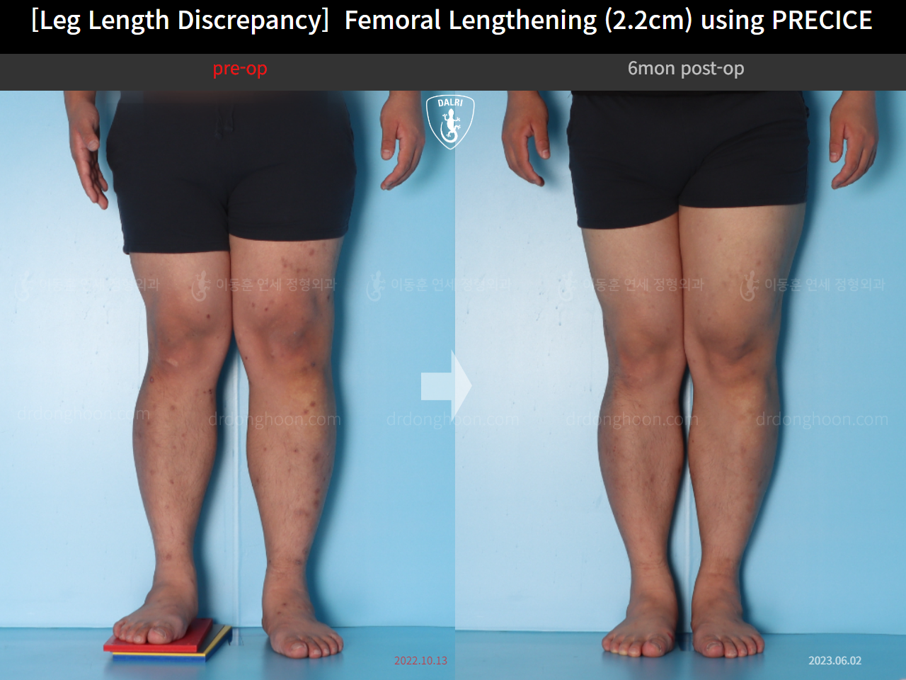 Before and after adult lld, case 15416698, image 5, Dr. Donghoon institute (DALRI)