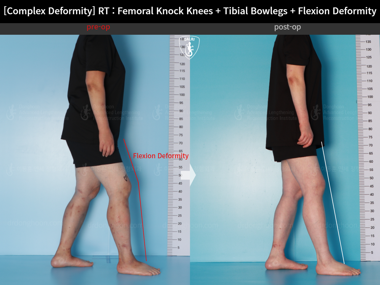 Before and after adult bowlegs, case 16507044, image 5, Dr. Donghoon institute (DALRI)