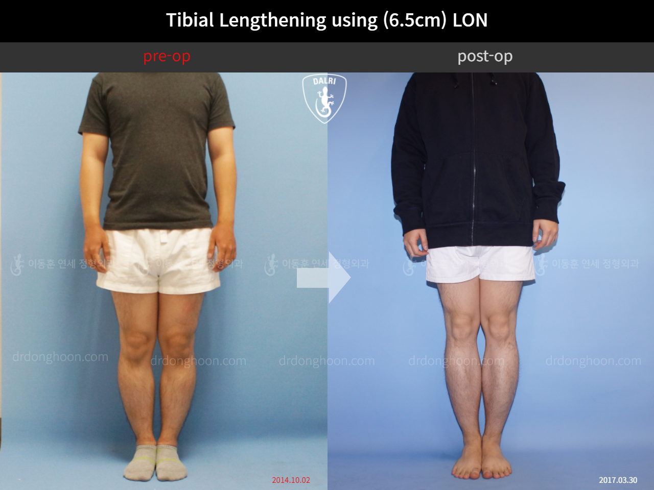 Before and after cll lon, case 4323455, image 1, Dr. Donghoon institute (DALRI)