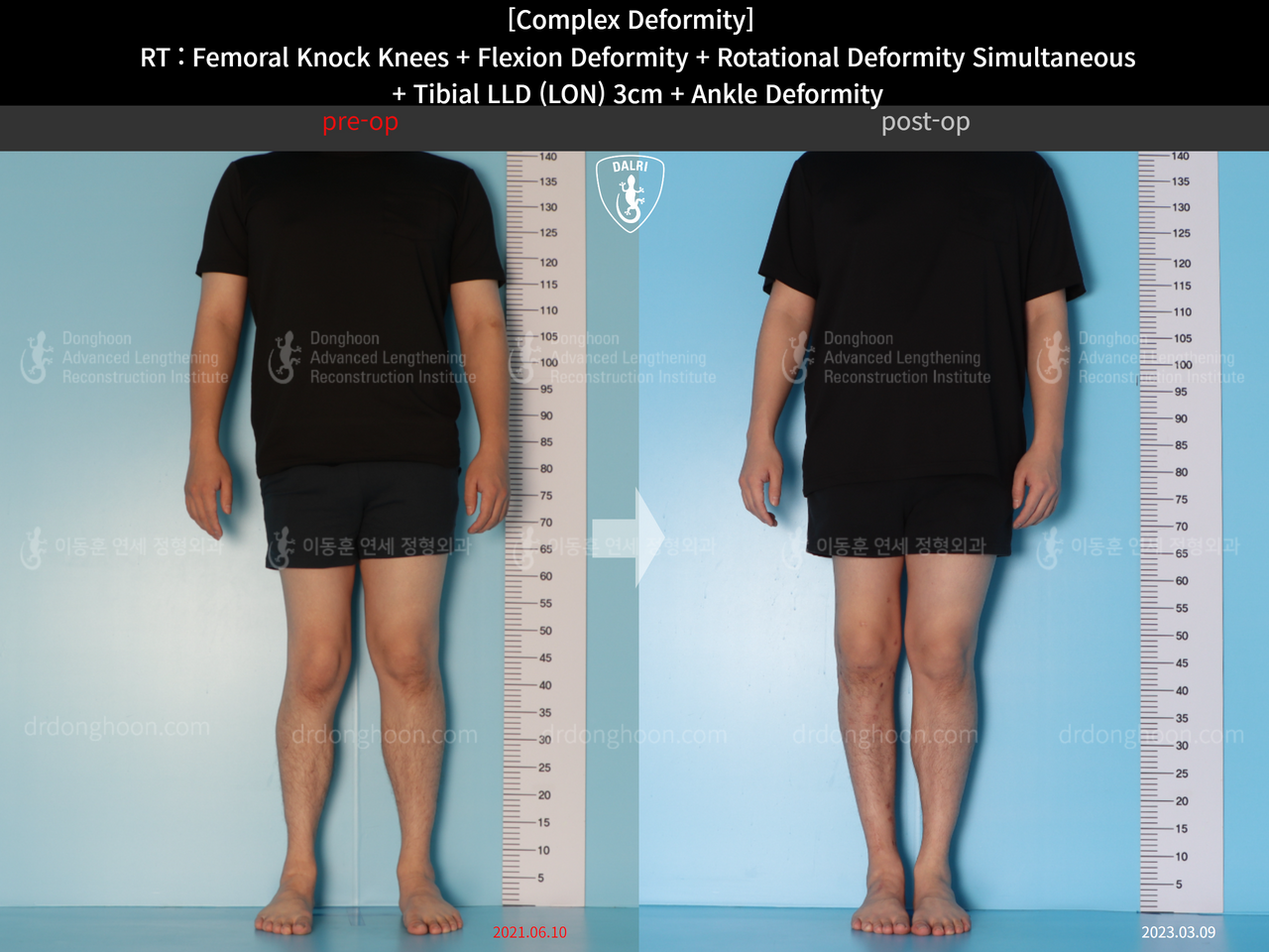 Before and after adult lld, case 14286604, image 3, Dr. Donghoon institute (DALRI)