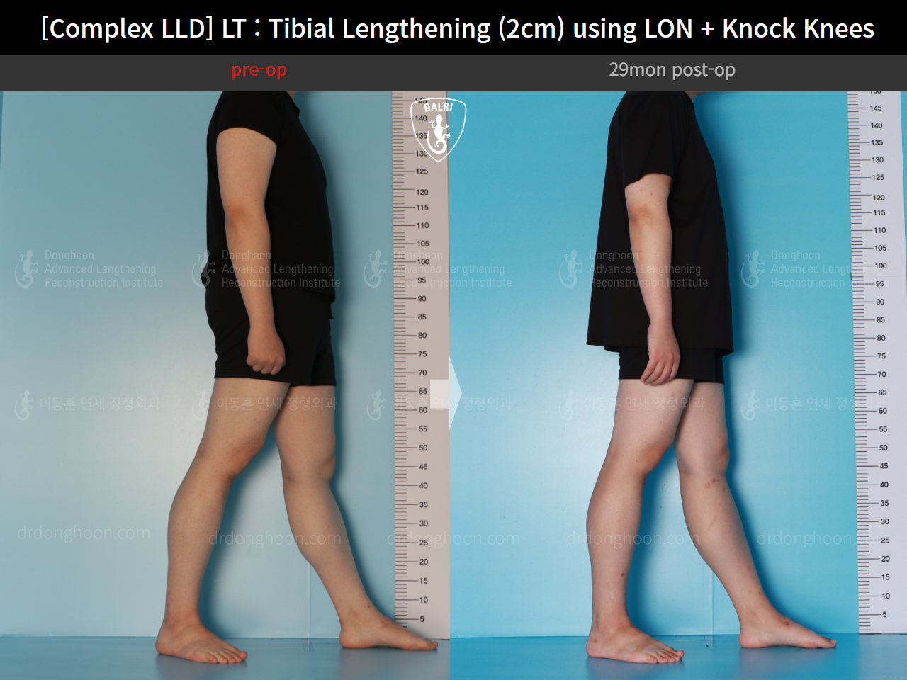 Before and after adult lld, case 16165477, image 4, Dr. Donghoon institute (DALRI)