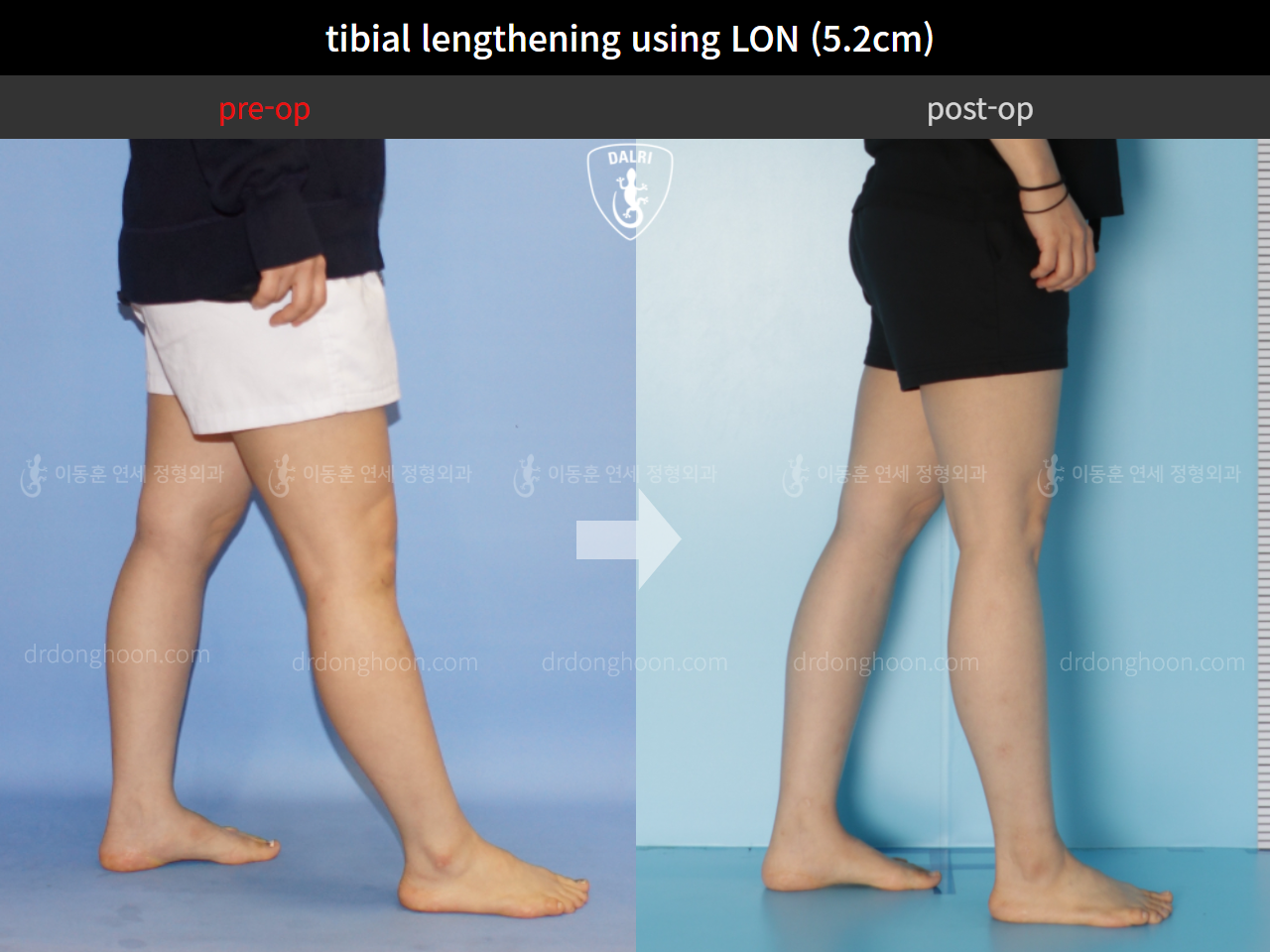 Before and after cll lon, case 4860933, image 7, Dr. Donghoon institute (DALRI)