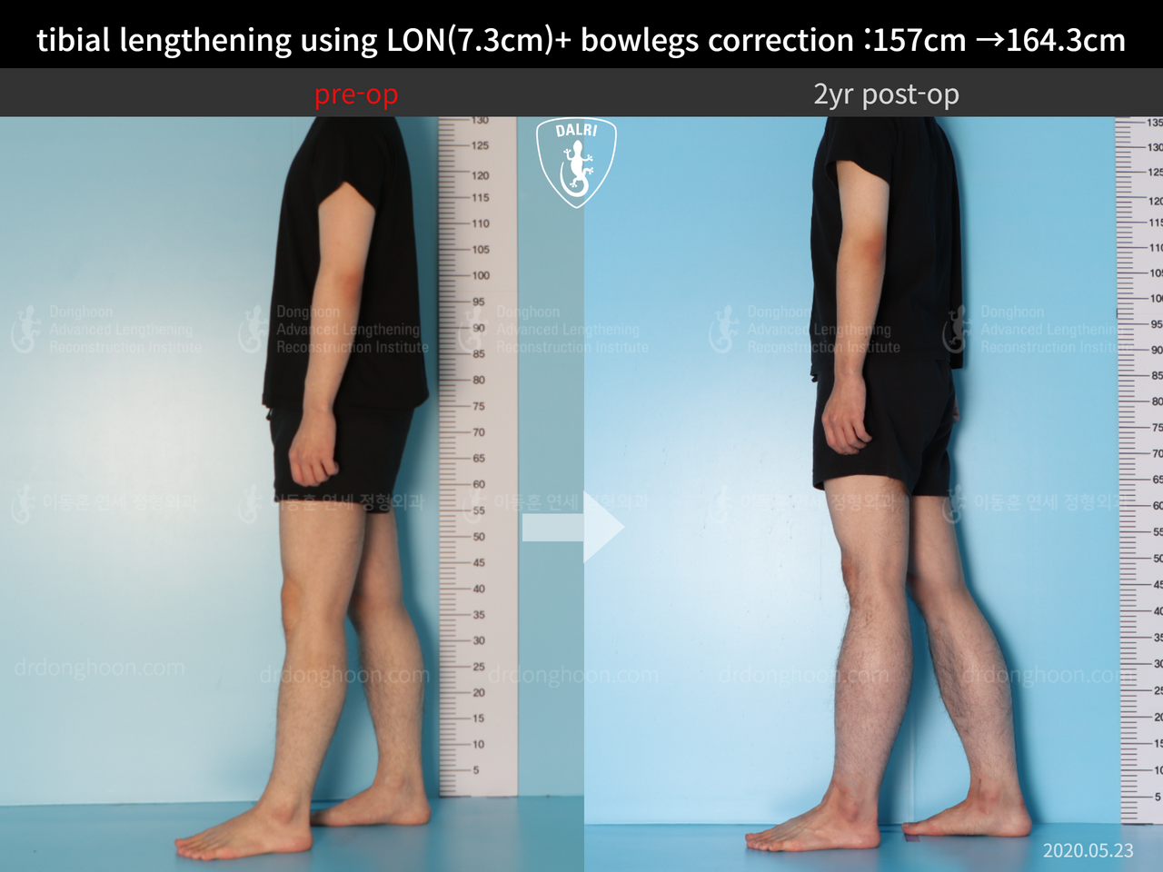 Before and after cll + deformity correction, case 13549500, image 4, Dr. Donghoon institute (DALRI)