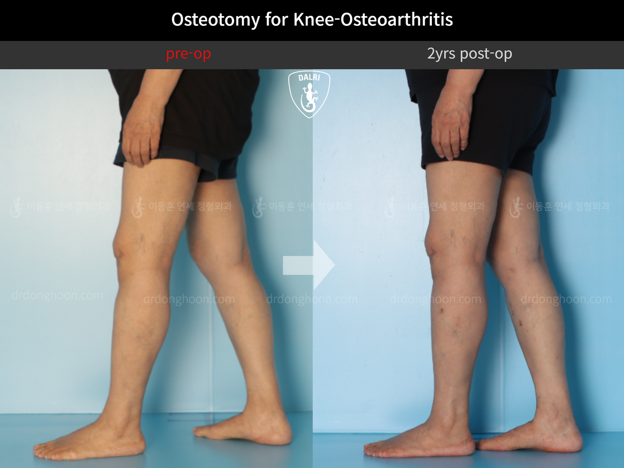 Before and after osteotomy for knee osteoarthritis, case 12844528, image 7, Dr. Donghoon institute (DALRI)