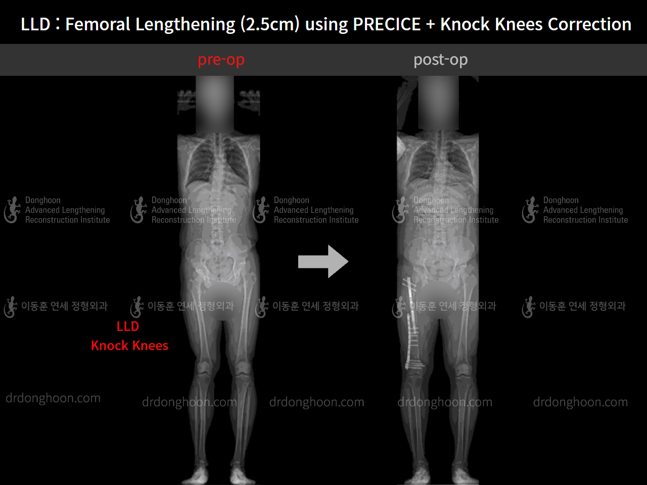 Before and after adult lld, case 9016415, image 4, Dr. Donghoon institute (DALRI)