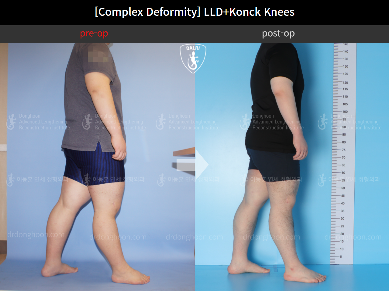 Before and after complex deformity, case 10564251, image 3, Dr. Donghoon institute (DALRI)