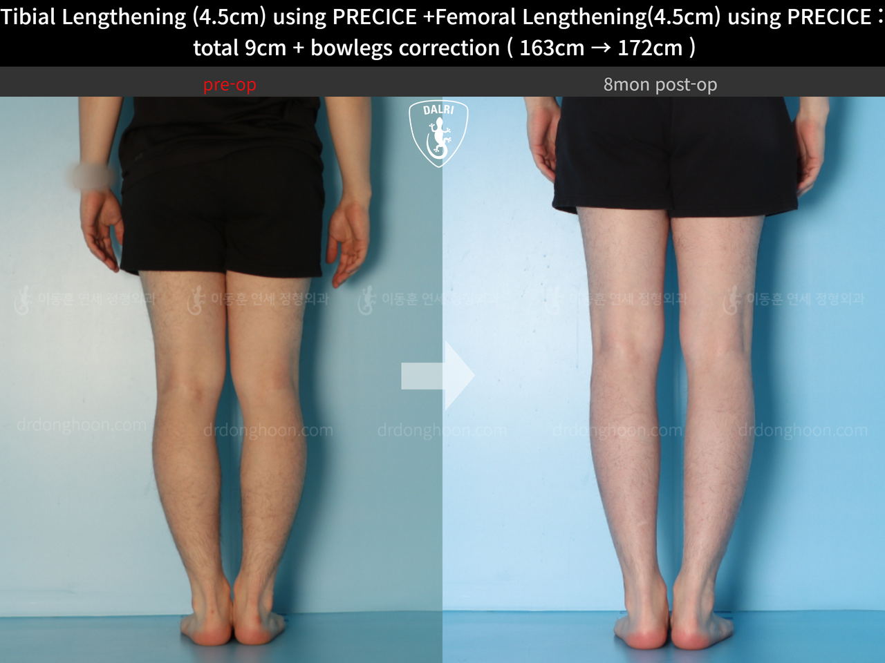 Before and after cll precice, case 13912585, image 10, Dr. Donghoon institute (DALRI)