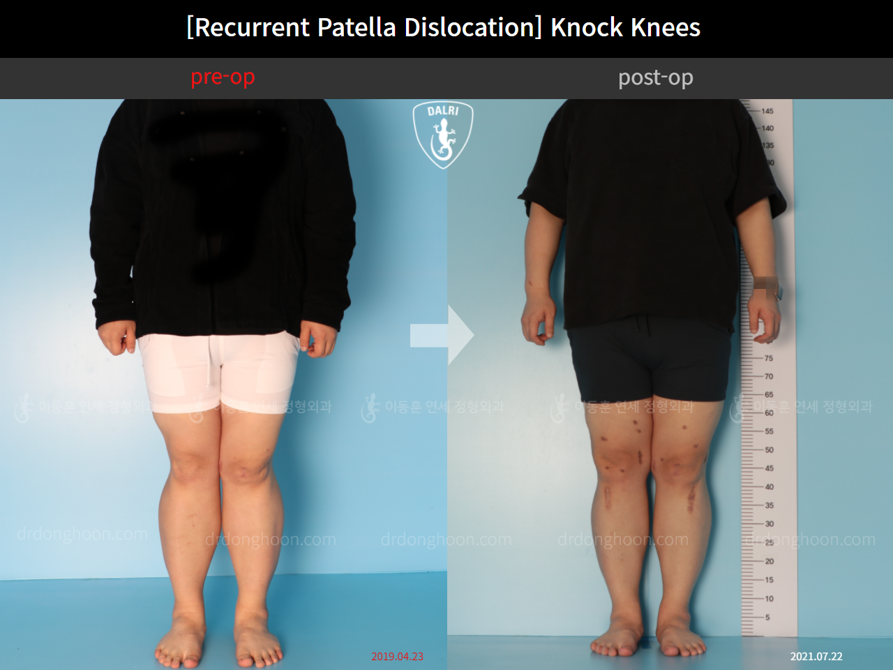 Before and after recurrent patella dislocation, case 10710327, image 3, Dr. Donghoon institute (DALRI)
