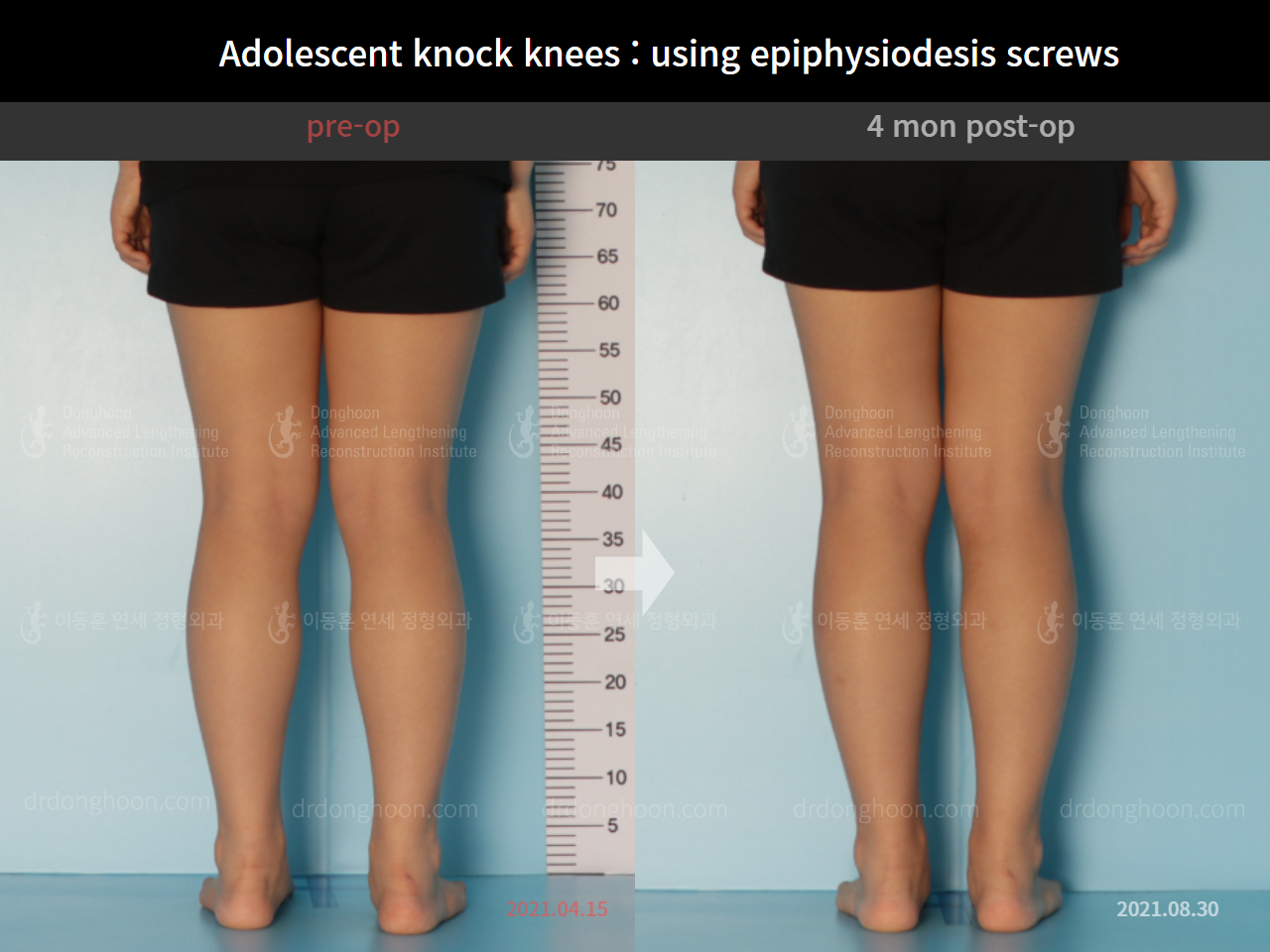 Before and after paediatric & adolescent knock knees, case 7977107, image 4, Dr. Donghoon institute (DALRI)