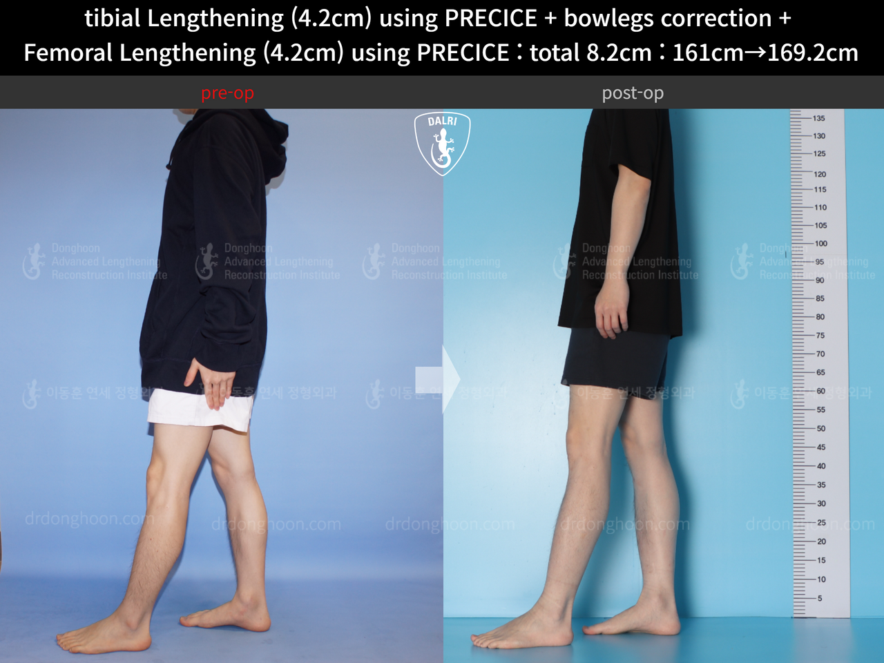 Before and after cll + deformity correction, case 14235715, image 4, Dr. Donghoon institute (DALRI)