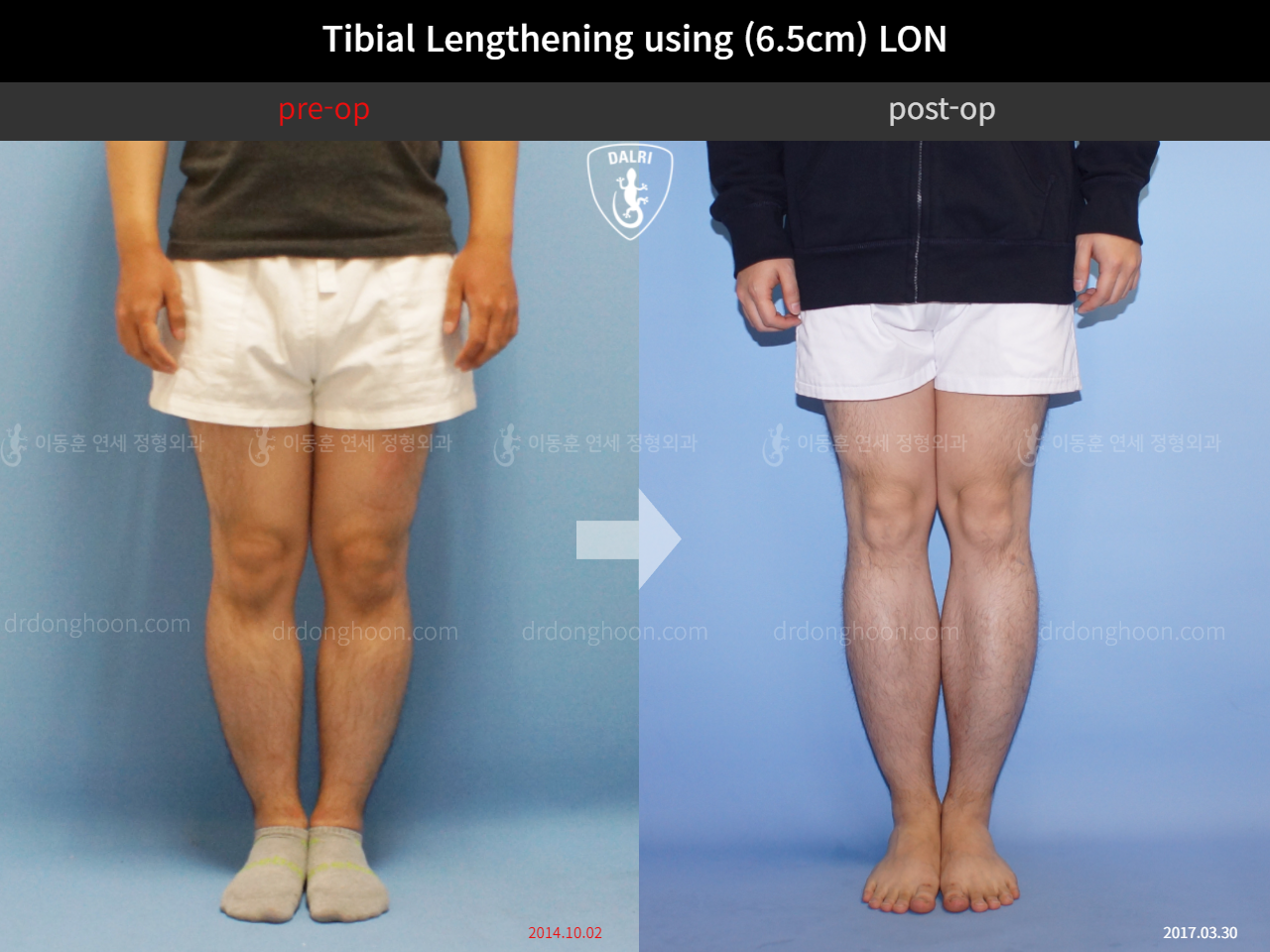 Before and after cll lon, case 4323455, image 3, Dr. Donghoon institute (DALRI)