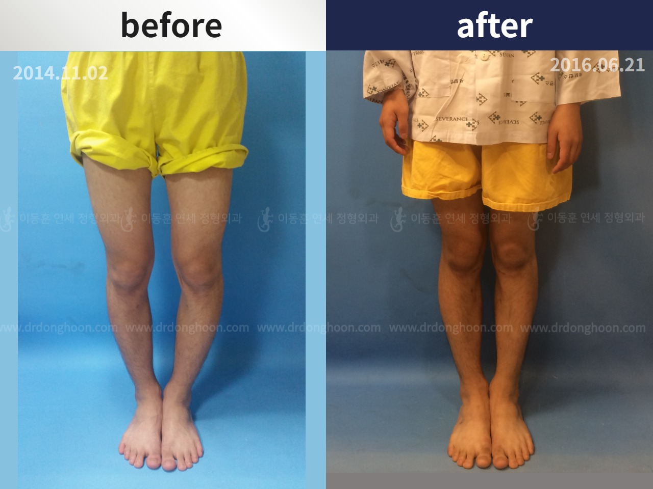 Before and after paediatric & adolescent bowlegs, case 4320233, image 1, Dr. Donghoon institute (DALRI)