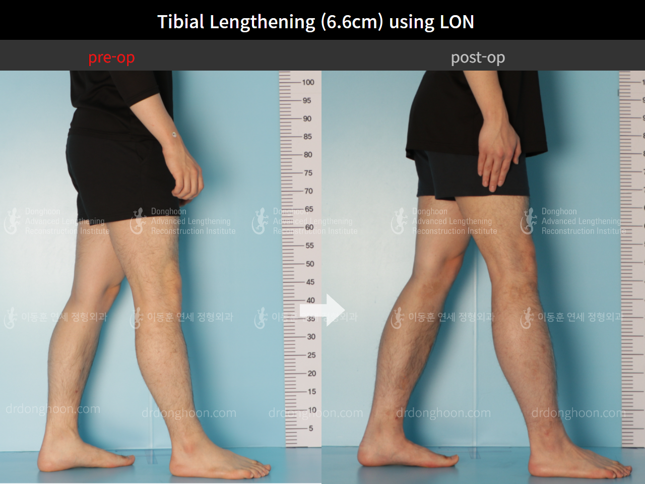 Before and after cll lon, case 8764128, image 7, Dr. Donghoon institute (DALRI)