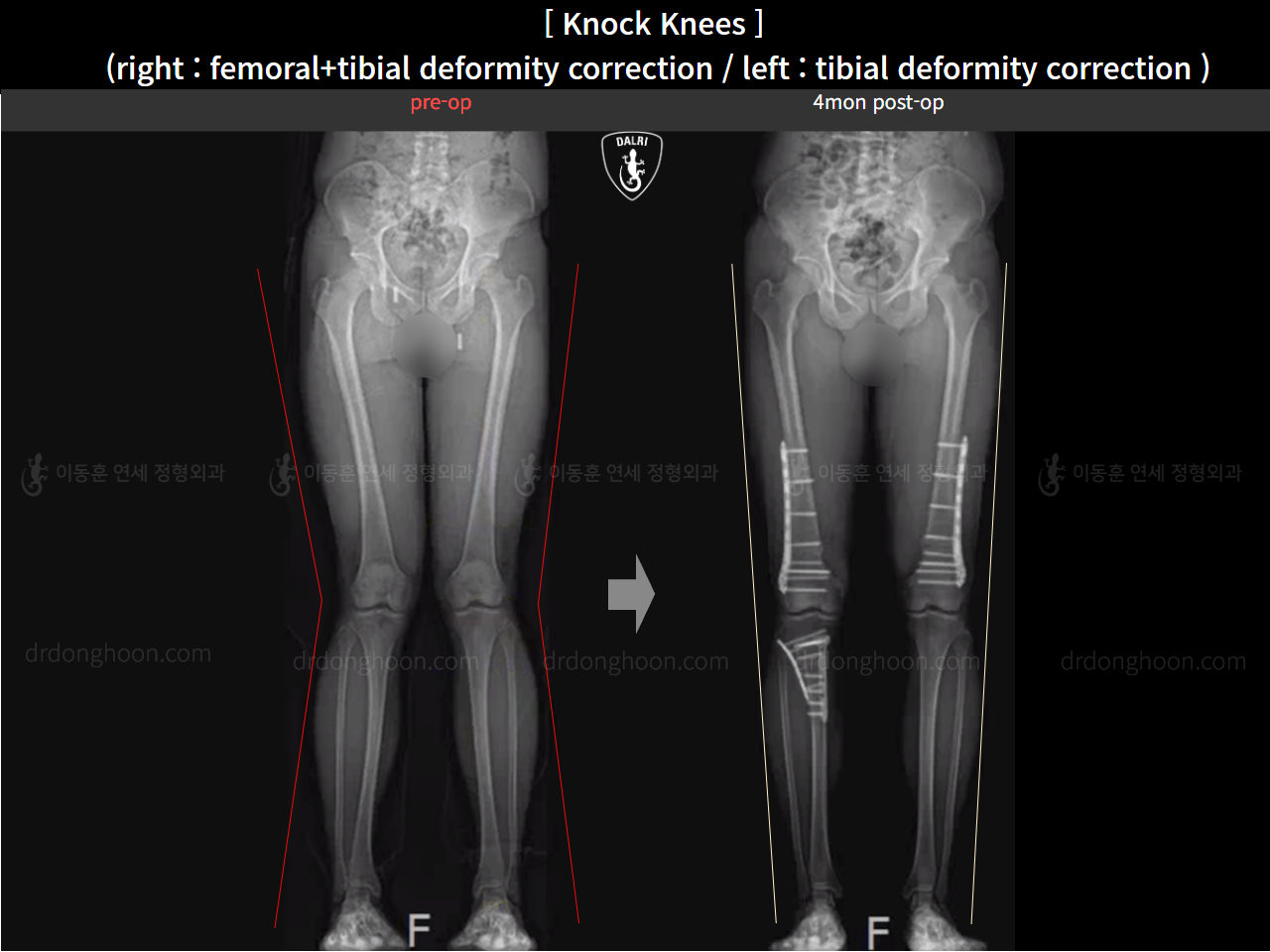 Before and after adult knock knees, case 22759789, image 2, Dr. Donghoon institute (DALRI)